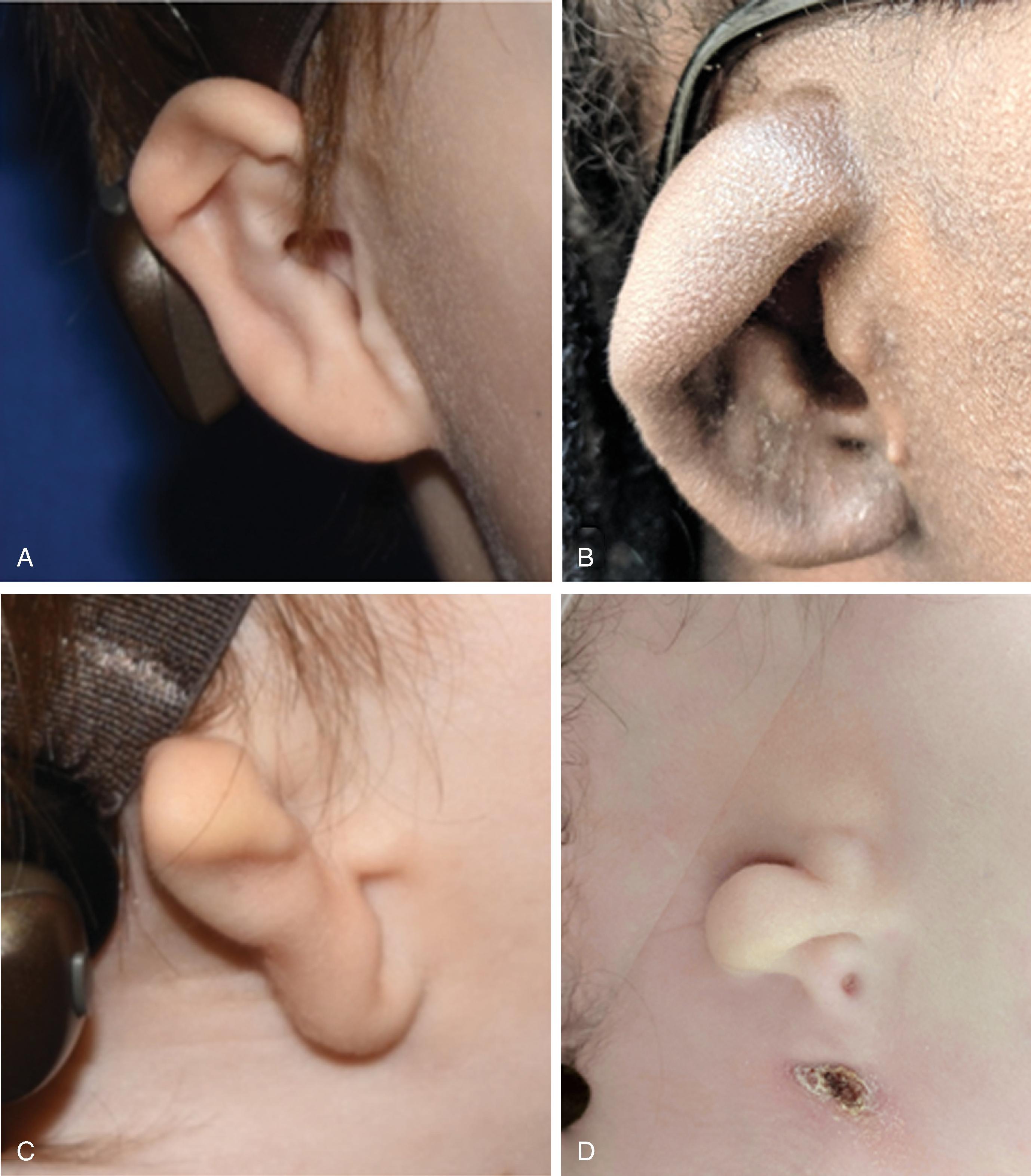 FIG. 23.3, Microtia Grades I to IV. A , In Grade I microtia, all of the auricular subunits are present but with some atypia. B , In Grade II, or conchal type microtia, the inferior aspect of the auricle is intact, notably the tragus/antitragus/intertragal incisor, and deformity is primarily confined to the superior half of the ear. C , Grade III, or lobular type microtia, has a preserved lobule often with a small residual remnant cartilaginous structure. D , Grade IV microtia, or anotia, has very little or no structure present. Of note, in this patient there is a first branchial cleft tract. Bone conduction devices are seen on the patients shown in A and C . Such devices are strongly recommended beginning at 6 to 9 months of age to promote binaural hearing.
