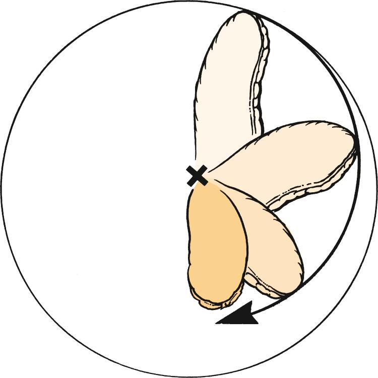 Fig. 21.2, The effective length of a pivotal flap moving through an arc of 180 degrees is reduced 40%.