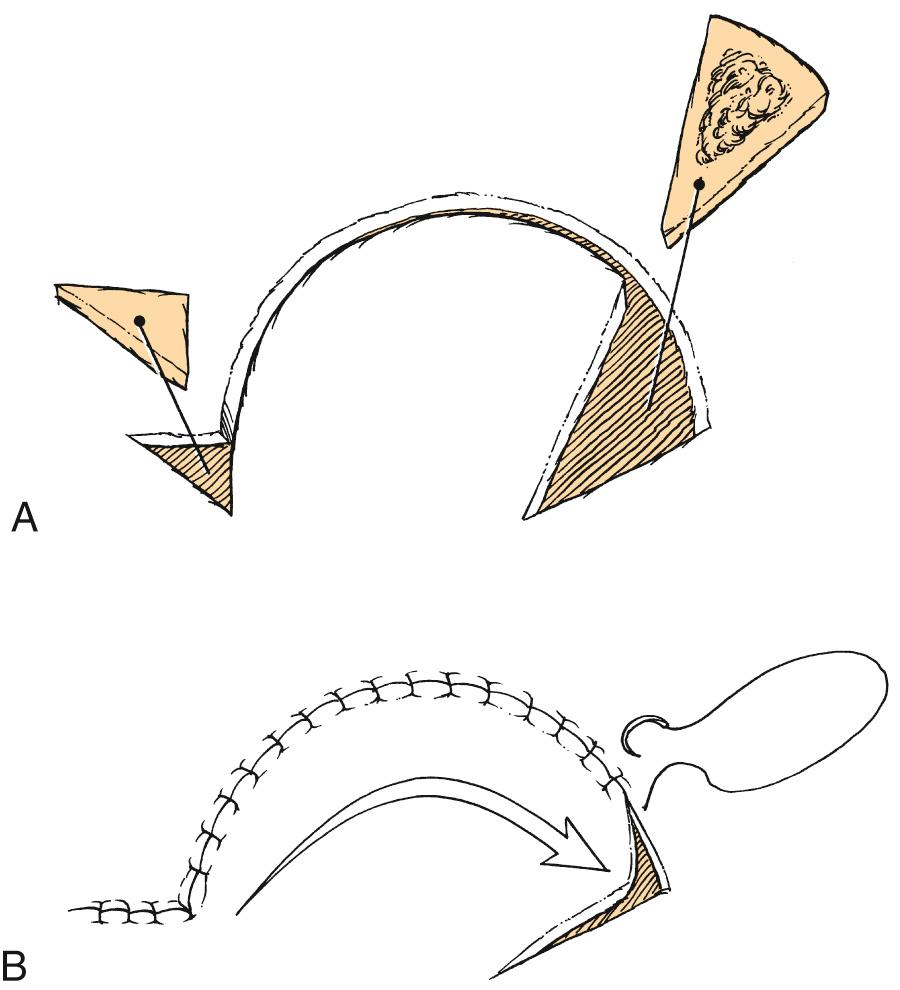 Fig. 21.3, (A) Rotation flaps are pivotal flaps with curvilinear configuration. Removal of a Burow triangle can facilitate repair of the donor site. (B) Standing cutaneous deformity will form at the base of the flap. Triangle-shaped defects use a portion of this redundant tissue.