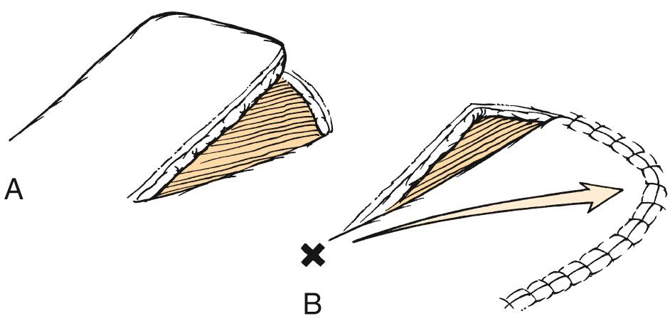 Fig. 21.4, (A) Transposition flaps have a linear configuration. (B) The flap turns around a pivot point at the base.