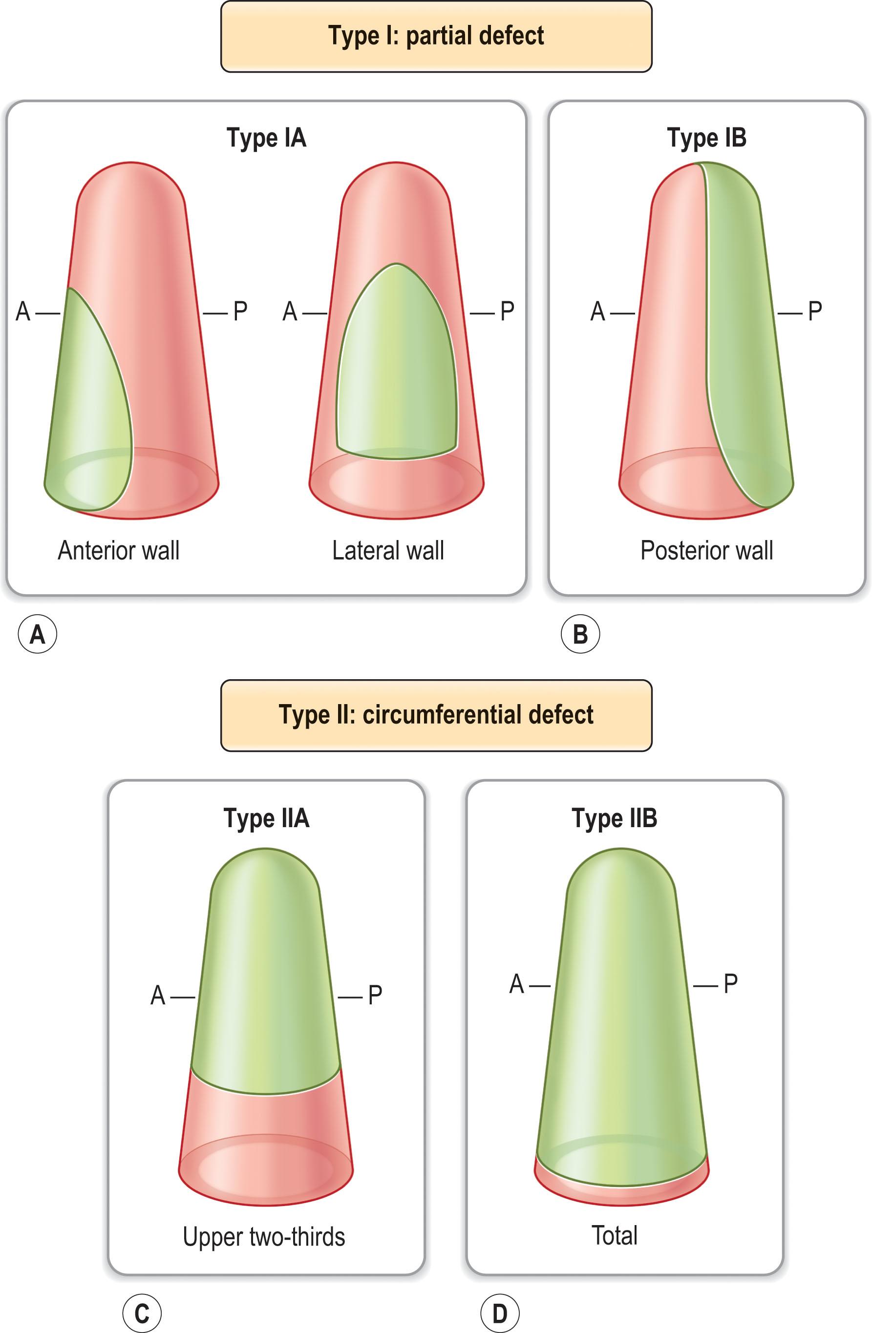 Figure 15.2, Classification system of acquired vaginal defects. (A,B) Type I: partial defect. (A) Type IA: partial defect of the anterior or lateral wall. (B) Type IIB: partial defect of the posterior wall. (C,D) Type II: circumferential defect. (C) Type IIA: circumferential defect of the upper two-thirds. (D) Type IIB: circumferential, total defect. A, anterior; P, posterior.