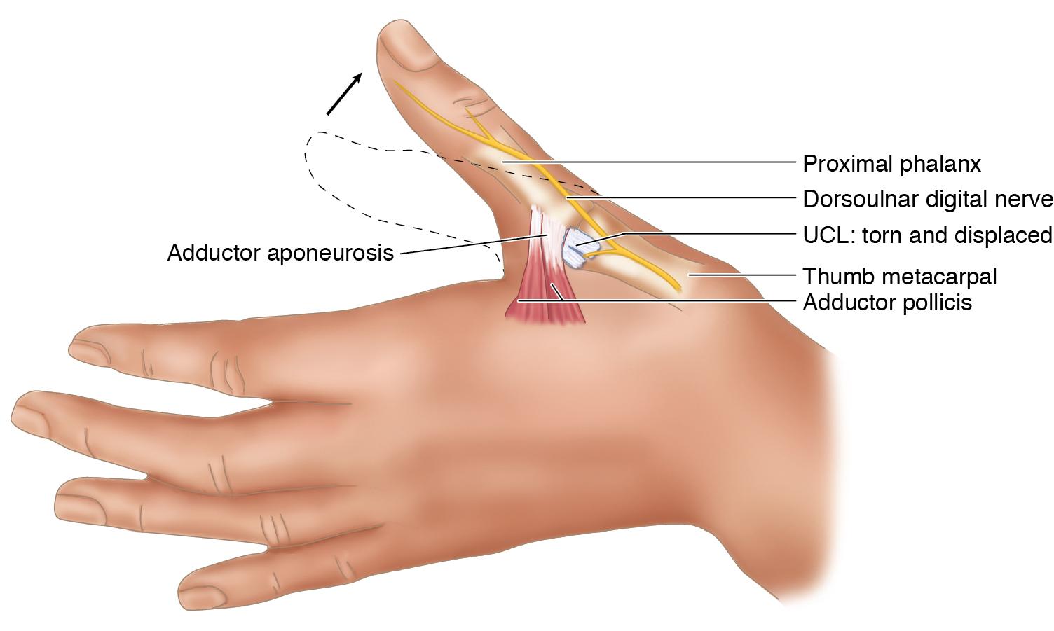 FIGURE 17.4, Ulnar collateral ligament (UCL) tear.