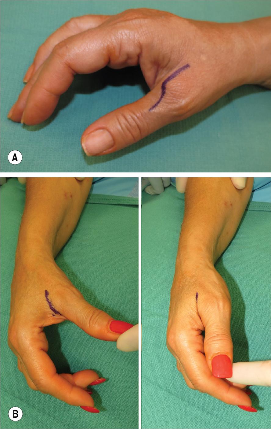 FIGURE 17.5, (A) Lazy-S incision design. (B) Incision hidden within the crease of the thumb.