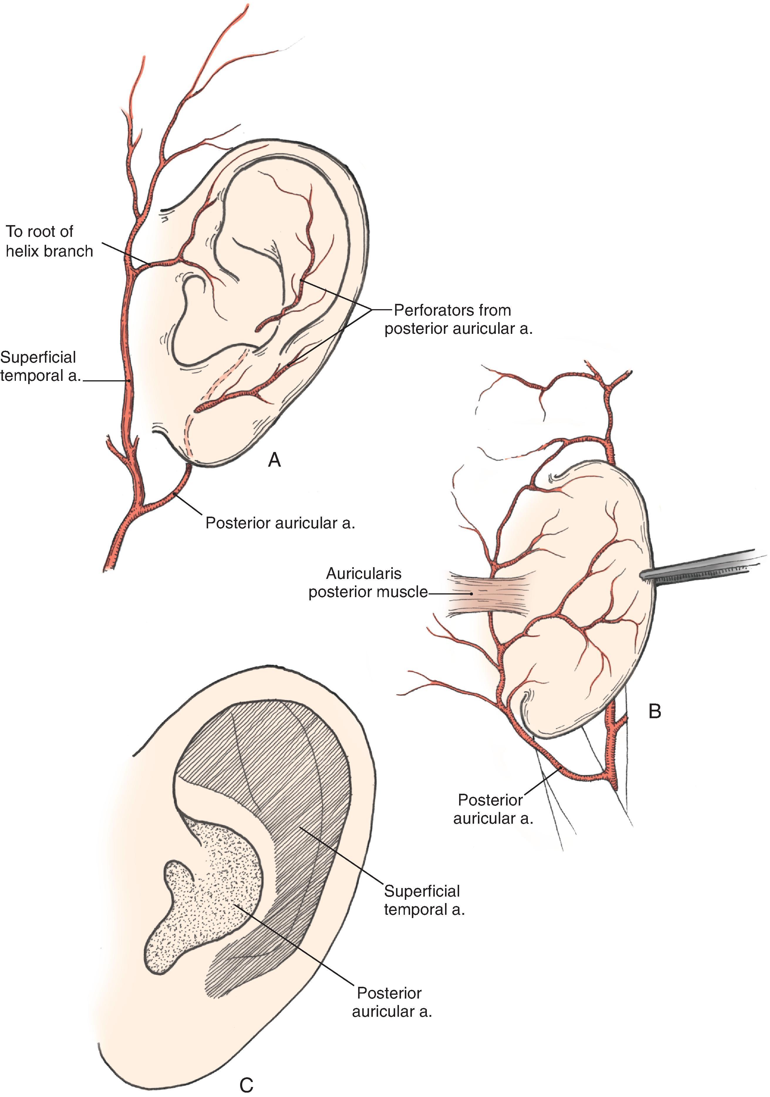 FIG. 22.2, Arterial blood supply to auricle. A , Lateral aspect. B , Medial aspect. C , Lateral aspect of auricle, with indicated zones supplied by superficial temporal and postauricular vascular systems.