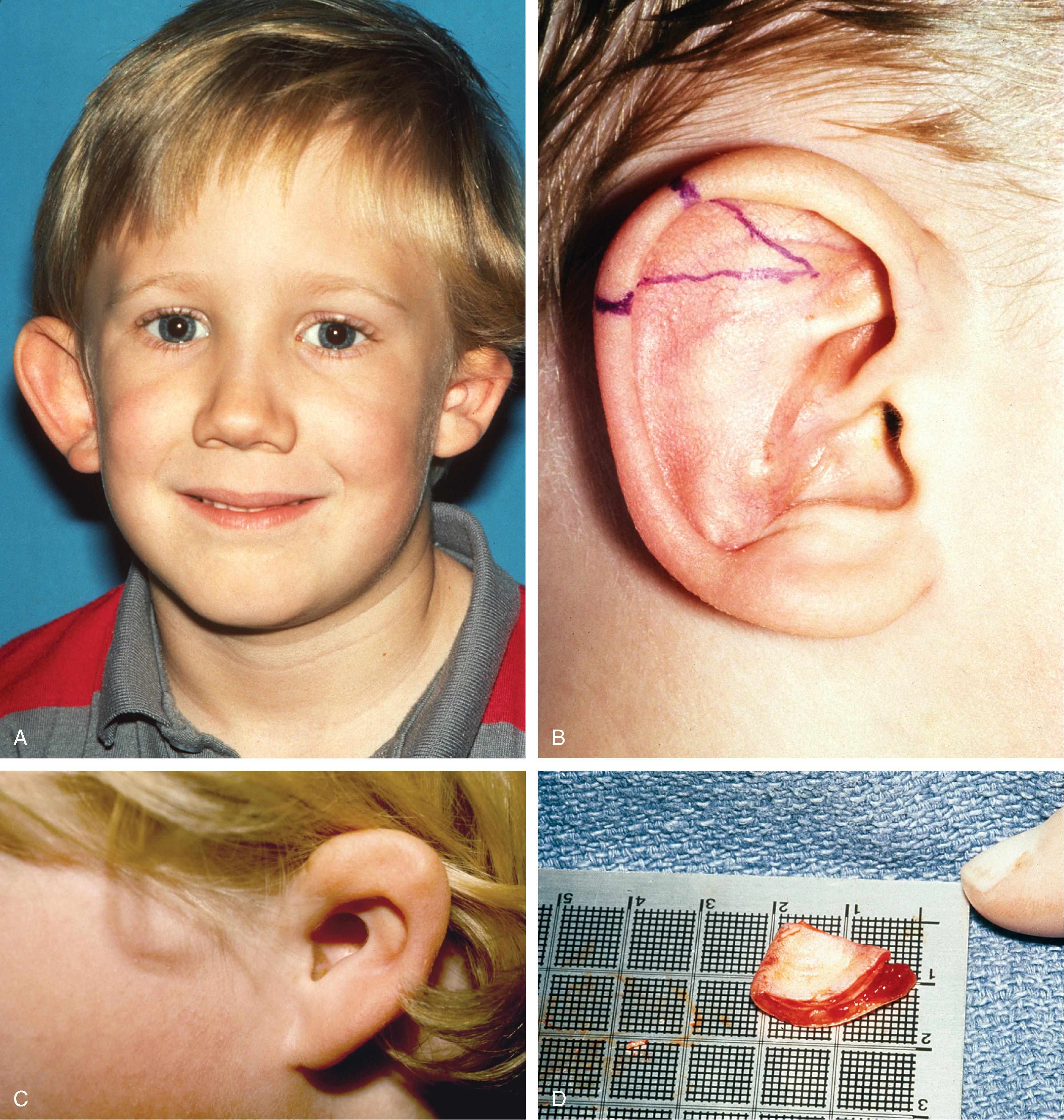 FIG. 22.5, Left congenital auricular deformity with greater than 20 mm difference in vertical height between auricles. A , Preoperative view. B , Donor ear composite graft outlined (one-half the size of recipient deficit height). C , Preoperative view of affected ear. D , Harvested composite graft. E , Graft in place. Vertical height increased by 1 cm. Epithelium removed from medial aspect of graft and medial aspect implanted in subcutaneous pocket. F , Postoperative result at 12 months.