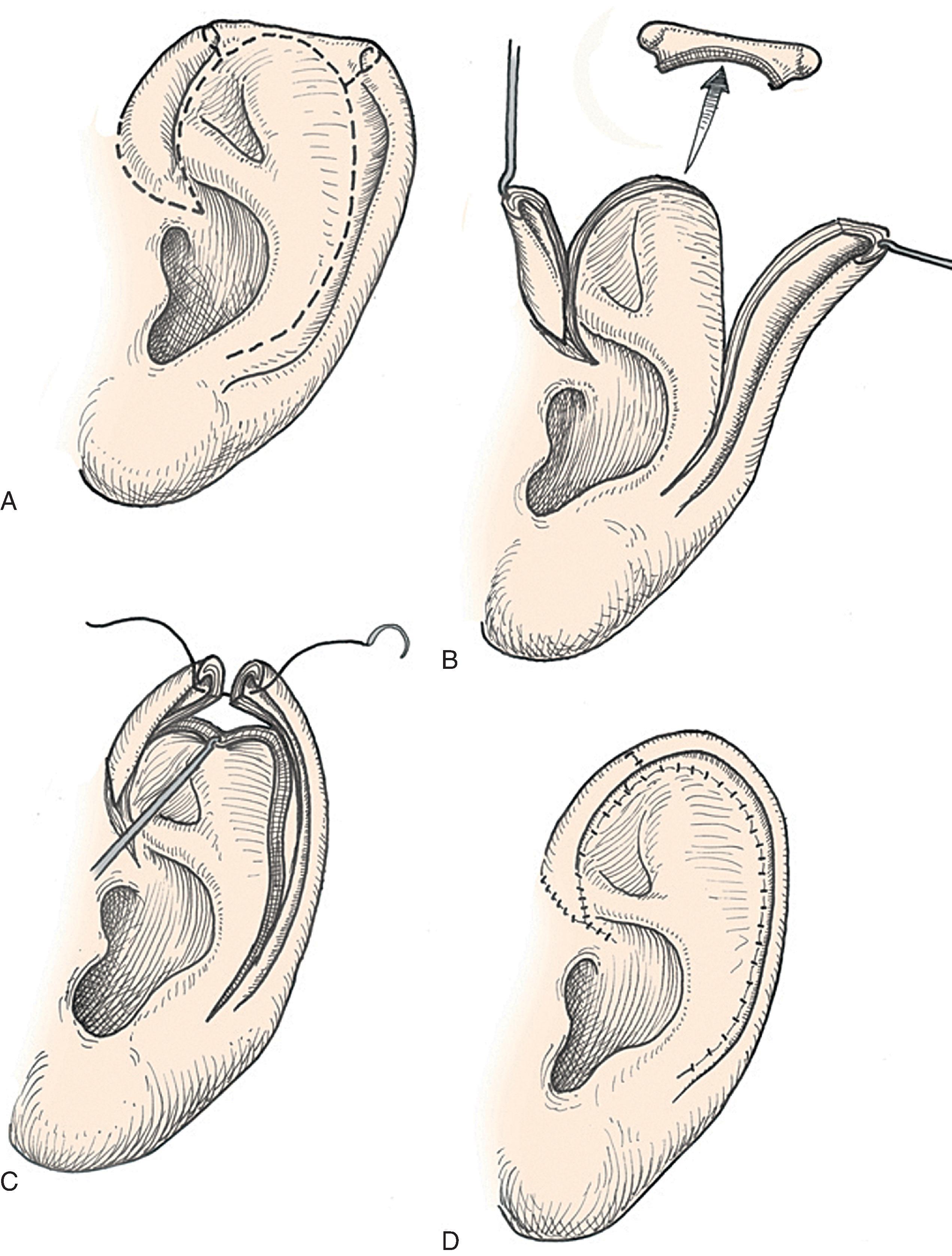 FIG. 22.6, Auricular chondrocutaneous composite flaps. A , Helical defect. Broken lines indicate incisions through skin and cartilage. B , Island advancement flap consisting of helical root advanced on medial soft tissue pedicle. Remaining helix pedicled on earlobe. C , Flaps advanced. D , Wound closure.