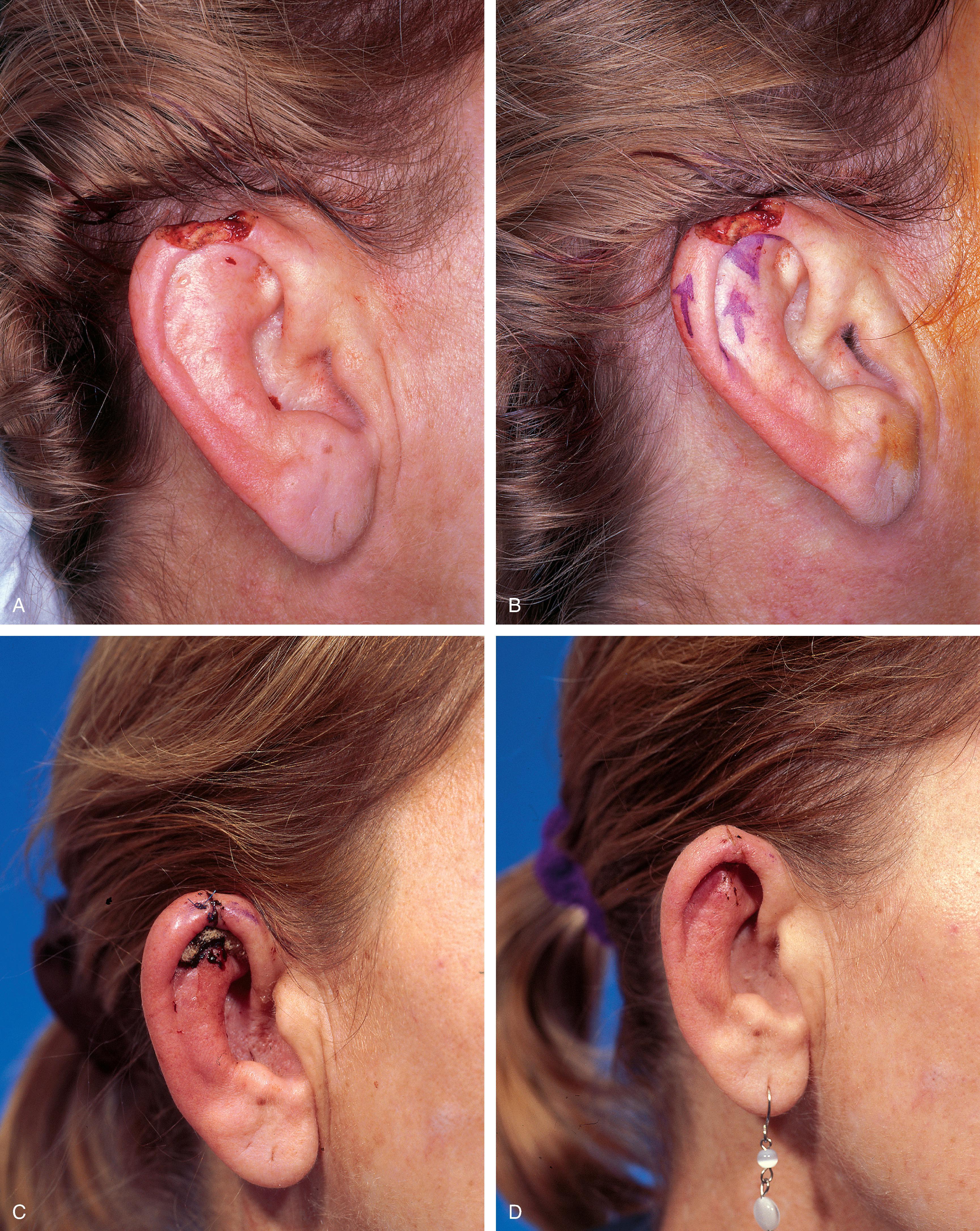 FIG. 22.7, A , A 1.5 cm full-thickness defect of helix. B , Unilateral chondrocutaneous composite helical advancement flap planned for repair. Burow triangle marked for excision to facilitate advancement. C , Flap in place. Bolster dressing secured with sutures to maintain contour of scapha. D. Postoperative result at 7 days. (Courtesy Shan R. Baker, MD.)