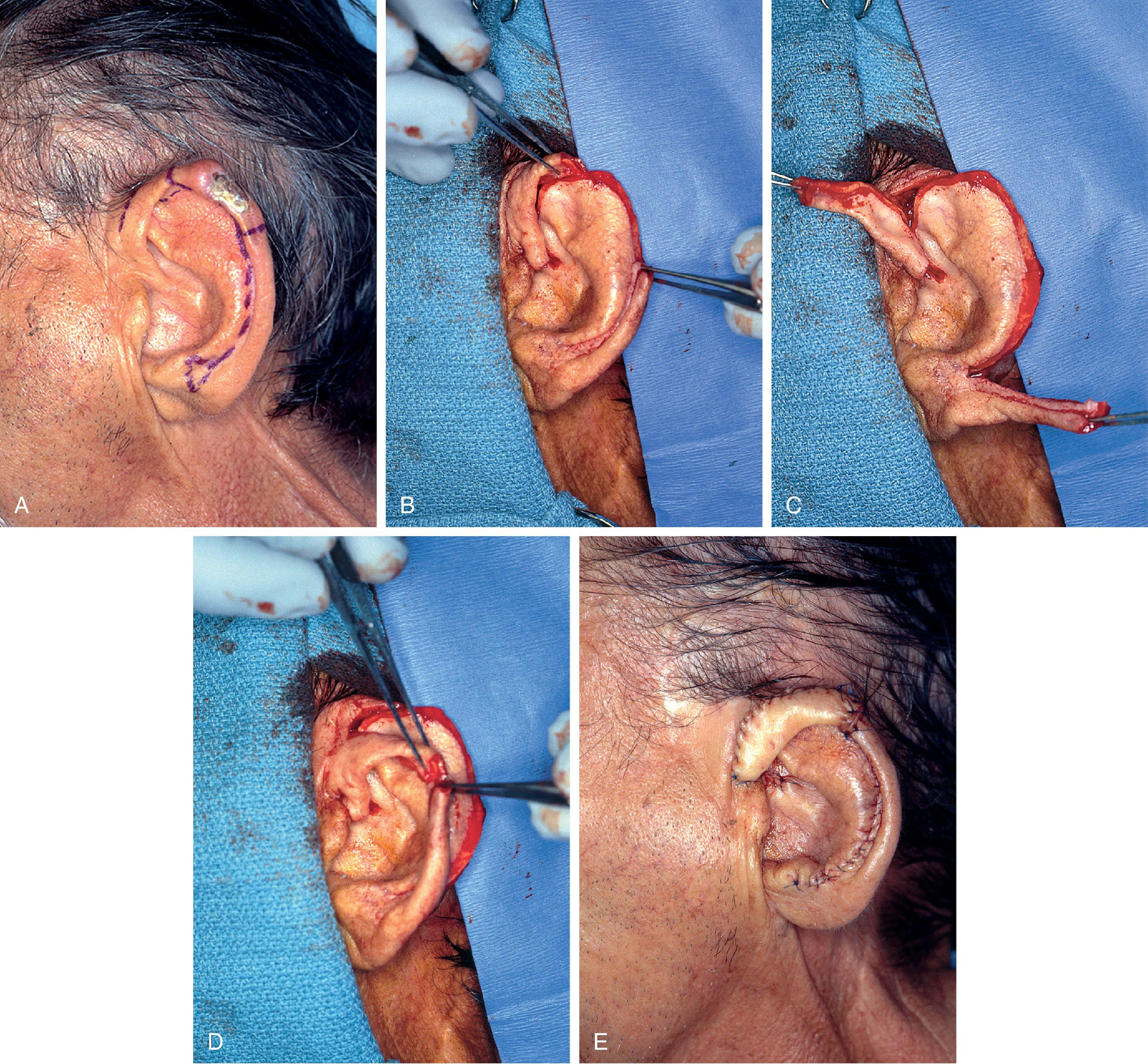 FIG. 22.8, A , Squamous cell carcinoma of helix marked for excision. Broken lines outline planned incisions for bilateral chondrocutaneous composite helical advancement flaps after excision of tumor. B , Tumor excised. One-third of helix removed. C , Advancement flaps incised. D , Apposition of flaps demonstrate requirement for reduction of scapha and superior antihelix. E , Wound closed after reduction. (Courtesy Shan R. Baker, MD.)