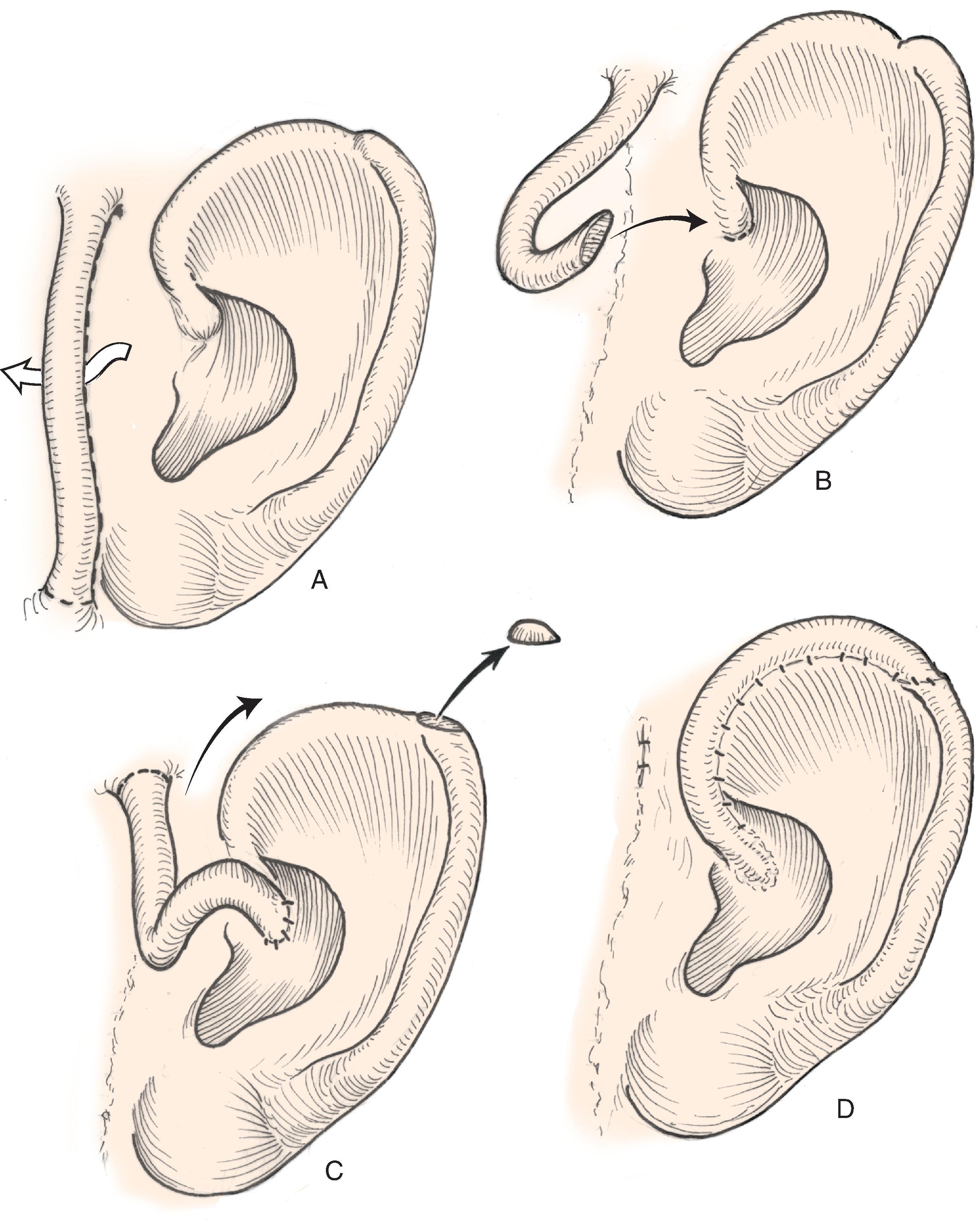 FIG. 22.9, Preauricular interpolated cutaneous tube flap for repair of defects confined to helix. A , First stage: tube created from preauricular skin. B , Second stage: division of inferior pedicle and flap transfer to helical root. C , Third stage: division of superior pedicle and flap inset. D , Final appearance after inset.