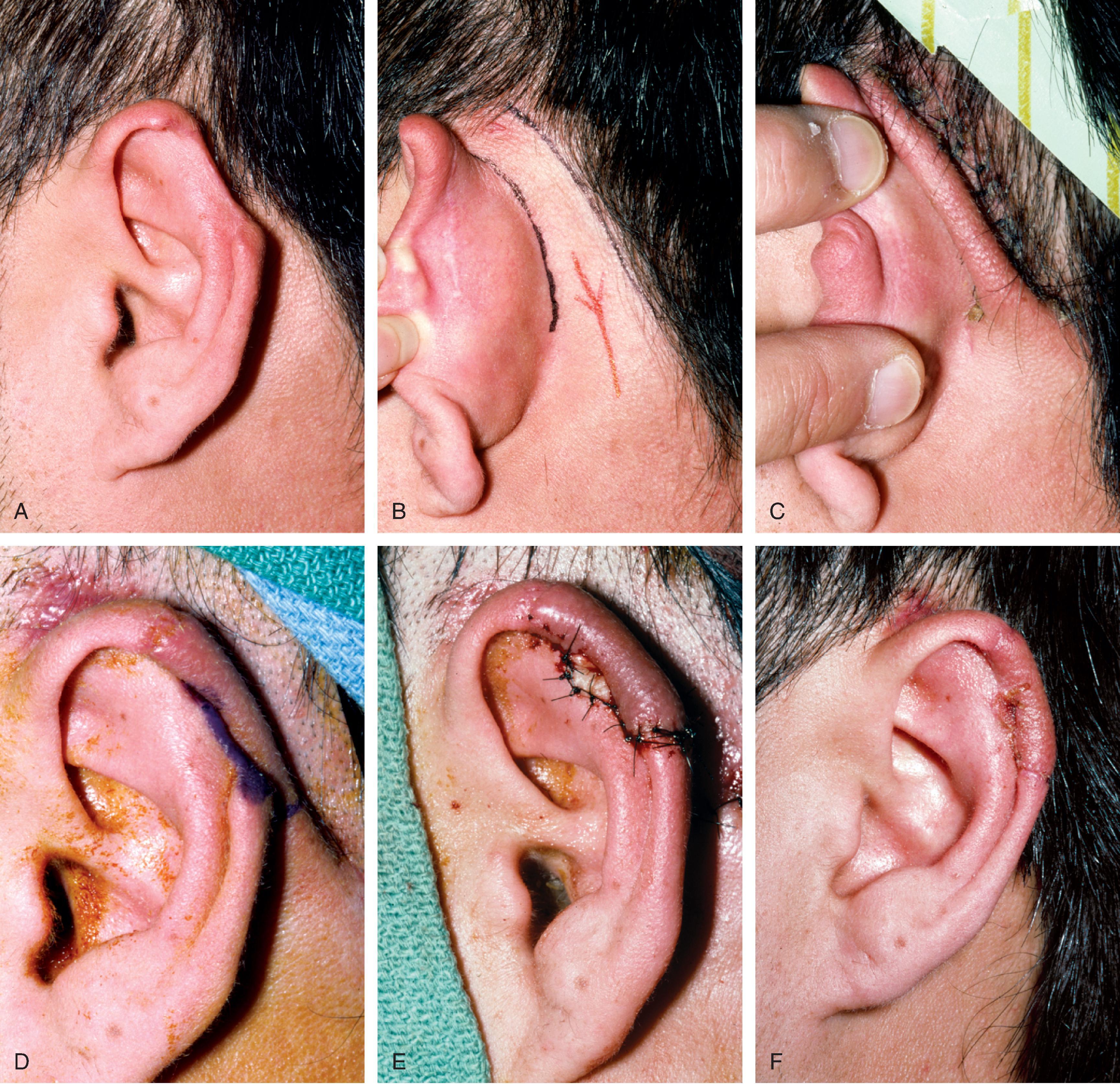 FIG. 22.10, A , Helical defect. B , Postauricular interpolated cutaneous tube flap designed. C , Three weeks after 1st stage tube creation. D , After second stage, transfer of flap to ear. E , Third stage flap inset. F , One month after third surgical stage.