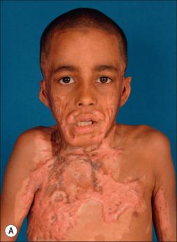 Fig. 50.1, (A,B) A 9-year-old boy from the Dominican Republic 2.5 years after 30% flame burns with severe hypertrophic scars and contractures. His chin was attached to his chest, and he had an axillary contracture that had been open for a year. (C,D) Five years later, after four Z-plasty procedures, six fractional ablative laser treatments, and one small split-thickness graft to the base of his right neck, his appearance and function are very close to normal. No scar tissue has been excised.