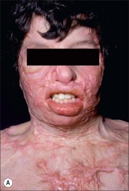 Fig. 50.11, (A,B) Typical examples of patients with “pan-facial” burns resulting in type II facial deformities.