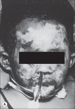 Fig. 50.2, (A) A 5-year-old Native American girl, 3 days after deep second- and third-degree burns to her face. (B) Tangential excision and split-thickness autografting were performed on the 10th postburn day. (C) Five years after facial excision and grafting. She has had a subsequent nasal reconstruction.