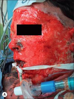 Fig. 50.3, (A) Ungrafted facial burn injury 30 days following 85% burn in a 34-year-old electrician. Wound closure was obtained with split-thickness grafts at 5 weeks. (B) Four years following burn injury. Lower lids and alar lobules have been released and grafted.