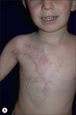 Fig. 50.4, (A) Four-year-old male 2 years after a mixed second- and third-degree scald burn from hot coffee. Parents refused excision and grafting. Scars are hypertrophic and inelastic with a significant contracture across the deltopectoral groove. (B) Multiple Z-plasties separated the scars into smaller, discreet areas with focal reductions in tension. Pulsed dye laser therapy was initiated at his first Z-plasty procedure. (C) Seven years later, after two small Z-plasty procedures and 21 laser treatments using both pulsed dye laser and fractional ablative CO 2 , his chest scars are flat, soft, thin, inconspicuous, and elastic. (D) Video demonstrating the function of the scars after treatment .