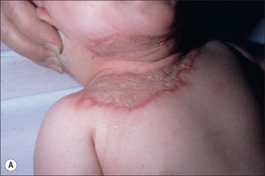 Fig. 50.5, (A) Eighteen-month-old female after a hot liquid scald burn following excision and grafting 2 weeks following the injury. (B) Appearance of the skin grafts at age 12. (C) Appearance of the grafts after 8 treatments with the fractional ablative CO 2 laser. (D) Video demonstrating the function of the grafts after treatment.