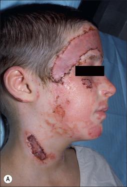Fig. 50.6, (A) One month following a flash burn, the right cheek is epithelialized. (B) Ten months later, there is massive hypertrophy despite conservative therapy with pressure.