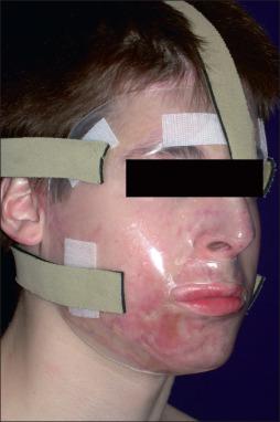 Fig. 50.7, Computer-generated clear silicone-lined masks are well tolerated and more efficacious than previous devices.