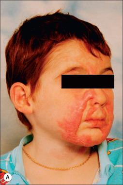 Fig. 50.10, (A) Hypertrophic scarring of both cheeks, lips, and chin 6 months following flame burn. (B) Multiple Z-plasties release tension on facial scars. (C) Pulsed-dye laser therapy can be used to decrease erythema. (D) Improved appearance 3 years following burn. No scars have been excised.