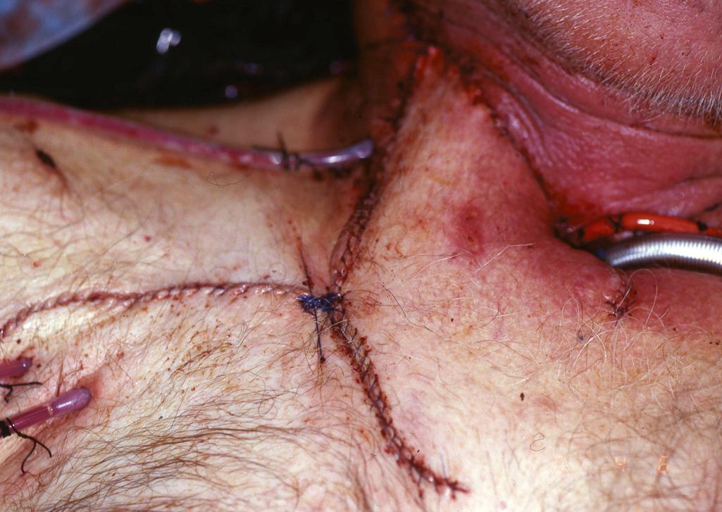 Fig. 103.3, Right deltopectoral flap rotated into ipsilateral neck as a second-layer closure for repair of a pharyngeal cutaneous fistula, which occurred after a total laryngectomy. The stoma seen in the photo is the tracheostoma, and the deltopectoral flap is shown after transposition and inset into the recipient bed.