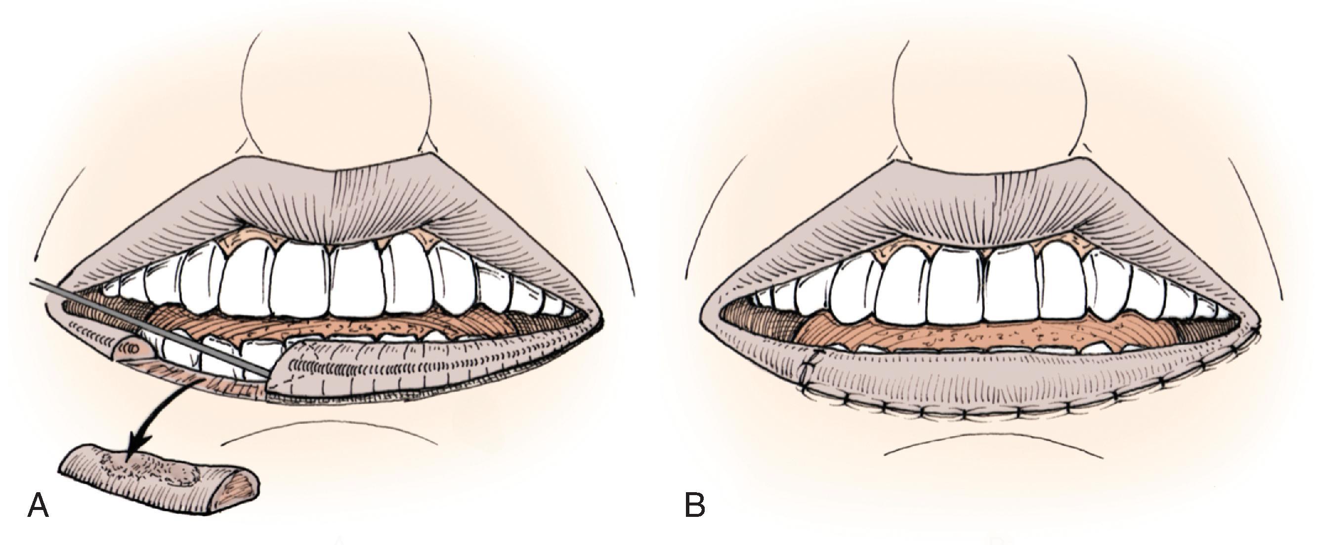 FIG. 19.11, A , Full-thickness vermilion defect. Full-thickness vermilion advancement flap incised. Bilateral opposing vermilion advancement flaps may also be used. B , Vermilion flap advanced and wound repaired. C , Full-thickness defect of vermilion and adjacent lip. Full-thickness transposition flap and vermilion advancement flap incised. D , Flaps transferred to recipient sites. E , Two flaps in place and wounds repaired.