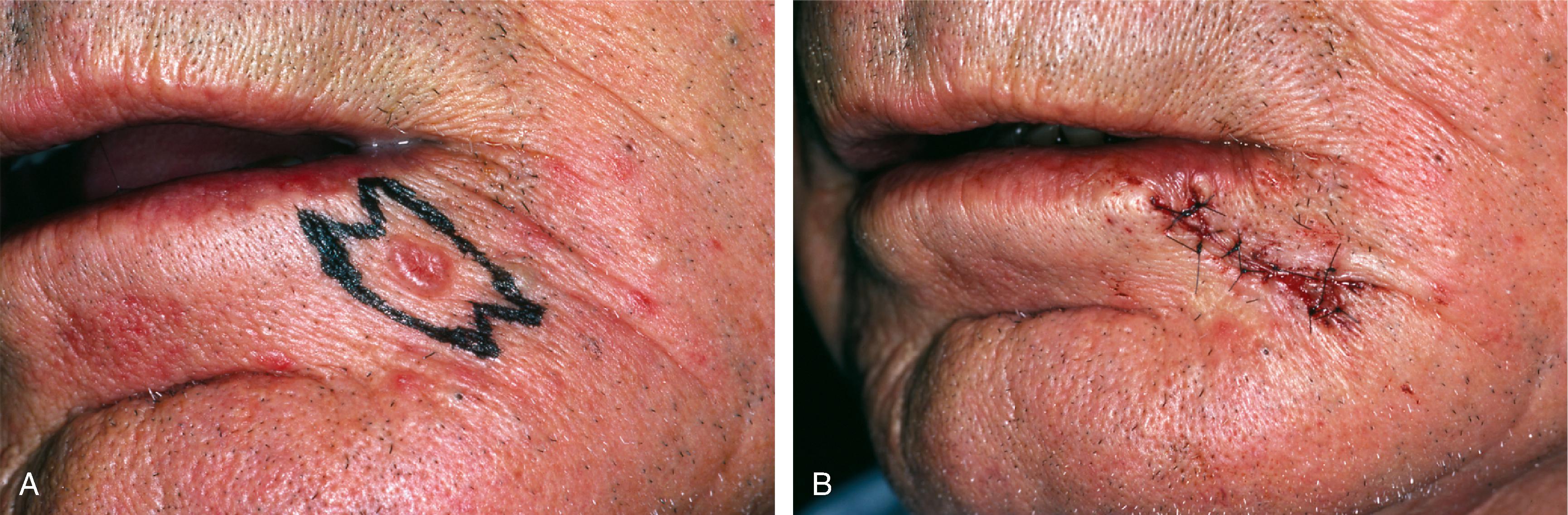 FIG. 19.13, A , Planned fusiform excision of skin cancer. M-plasties designed to minimize length of excision and avoid encroachment on vermilion. Orientation of excision parallel to relaxed skin tension lines of lip. B , Wound repaired after excision.