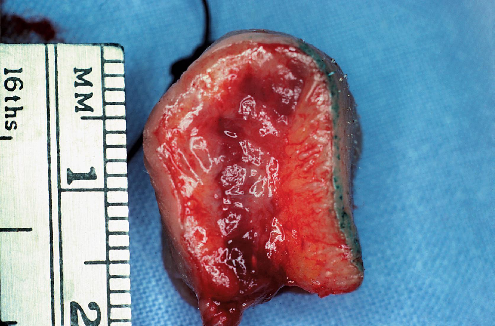 FIG. 19.2, Cross section of lip showing (from right to left) skin, muscle, and mucosa.