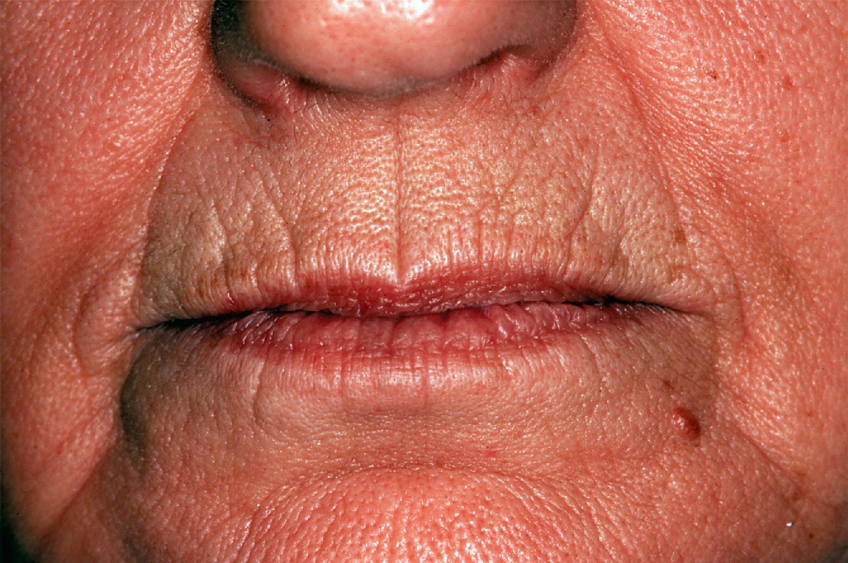FIG. 19.3, Aesthetic borders of lips marked by melolabial and labiomandibular creases on either side and mental crease inferiorly. Rhytids of lips parallel relaxed skin tension lines, which display radiant pattern about oral stoma.