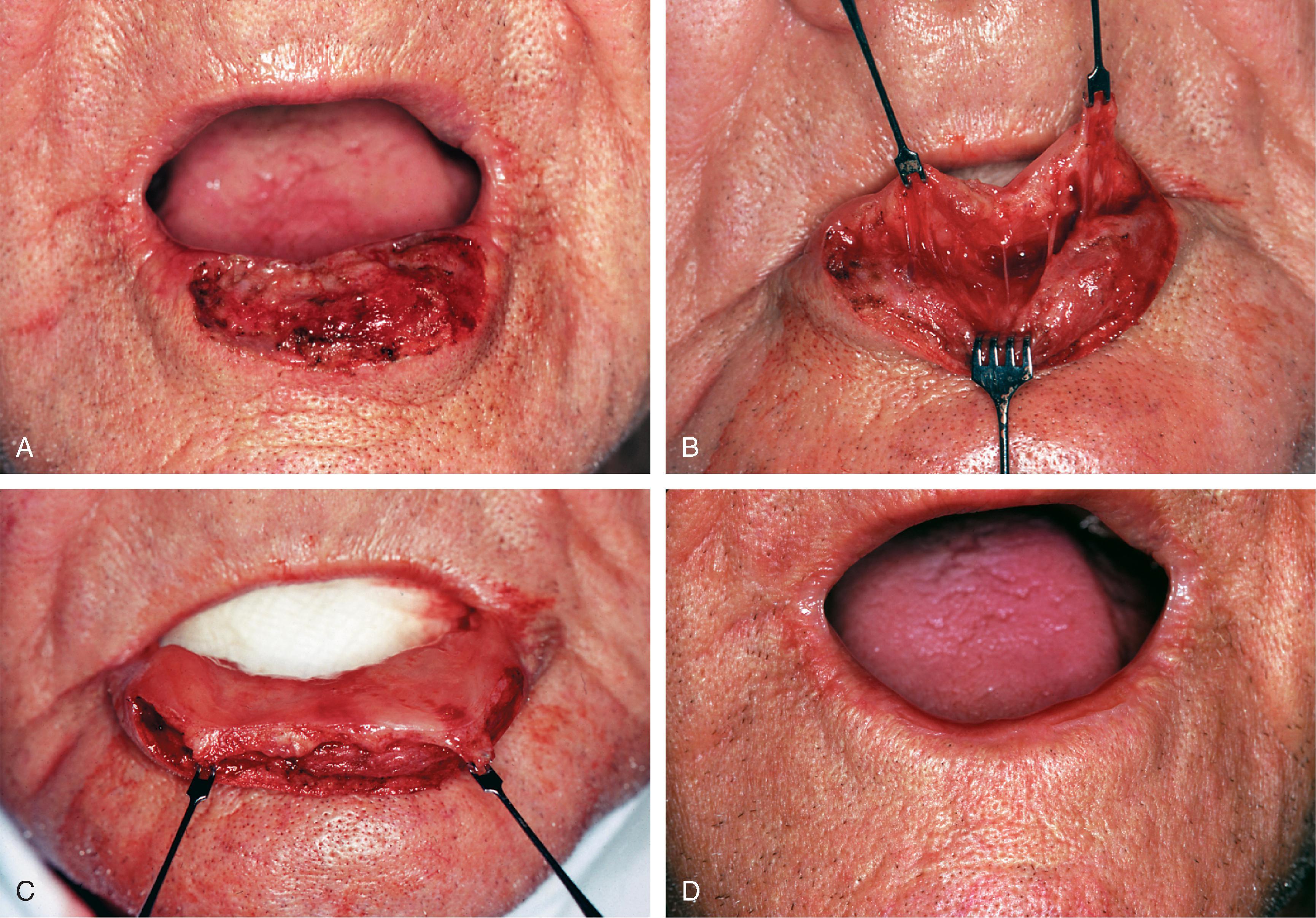 FIG. 19.4, A , A 4 cm × 1 cm defect of the lower lip vermilion and skin. B , Labial mucosal advancement flap dissected deep to minor salivary glands and immediately superficial to orbicularis muscle. C , Flap advanced. Margin of skin defect not dissected. Skin margin left to migrate cephalically by scar contraction. D , Anterior vermilion line in acceptable position. Continued scar maturation will reduce scar thickness.