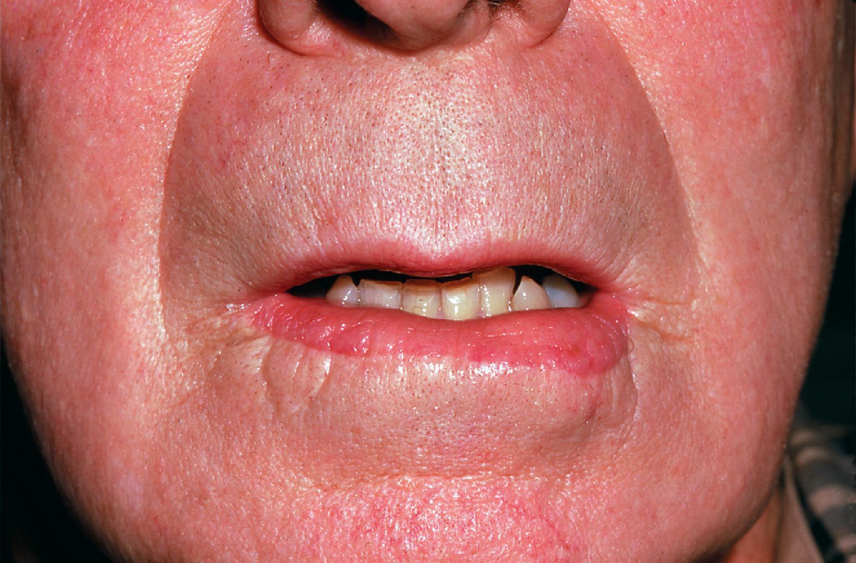 FIG. 19.5, Mucosal advancement flap used to reconstruct inferior vermilion. Color is darker red than natural vermilion.