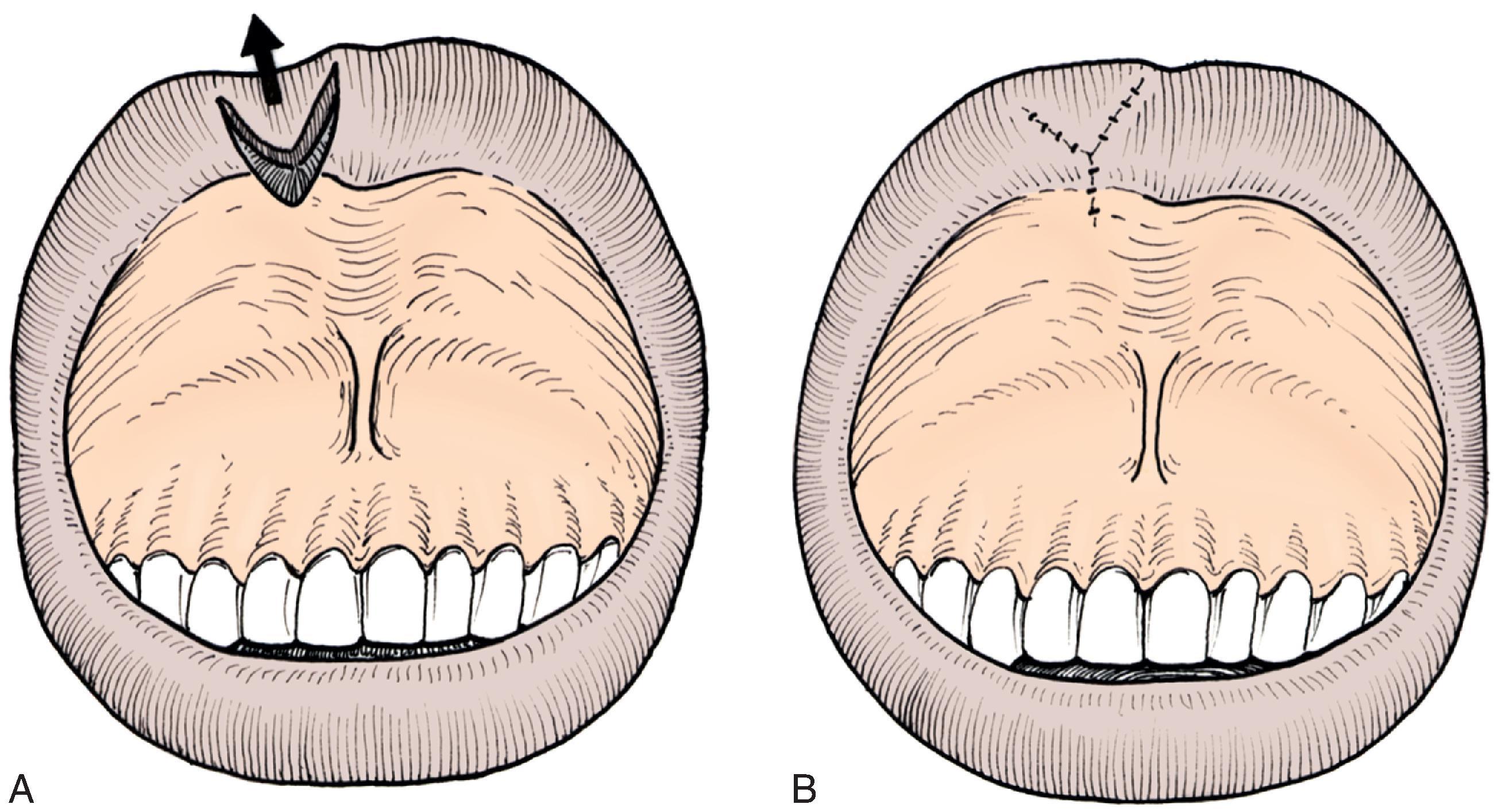 FIG. 19.6, A , V-to-Y mucosal advancement flap used to repair small deficiency of vermilion. B , Wound closure assumes Y-shaped configuration.