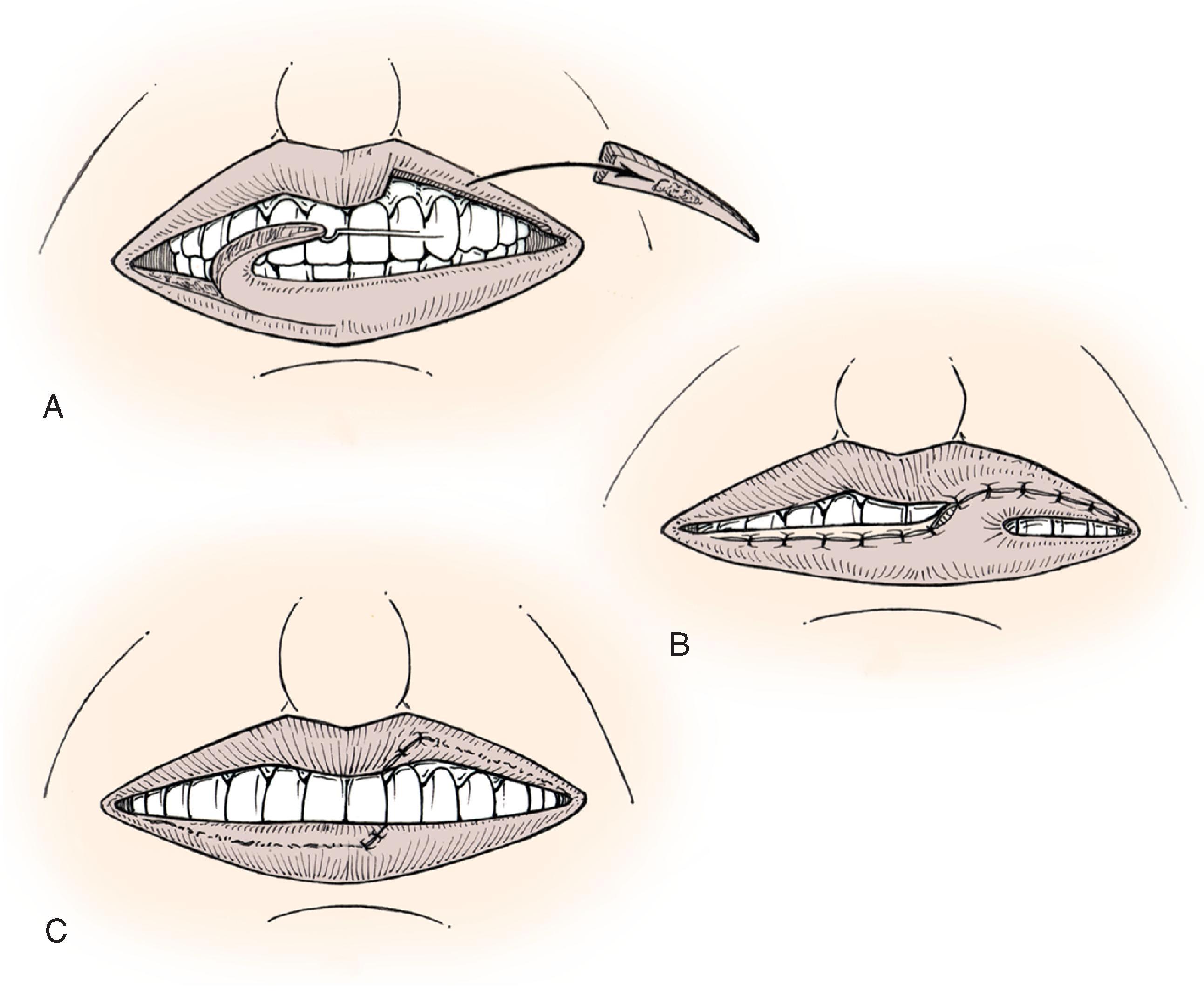 FIG. 19.7, A , B , Interpolated cross lip vermilion flap used to reconstruct vermilion defect of upper lip. Donor site repaired by advancing labial mucosa. C , Division of pedicle and flap inset.