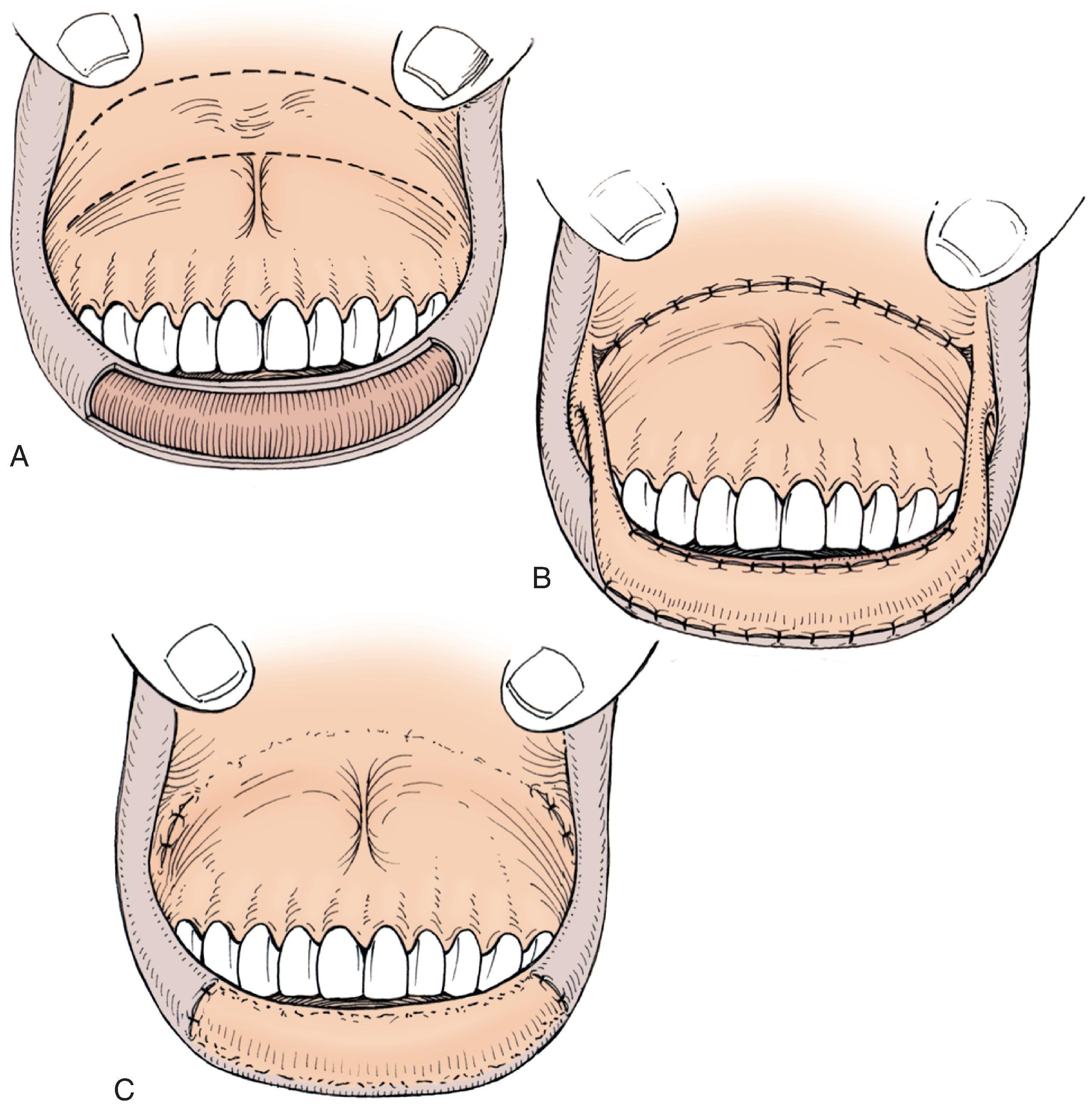 FIG. 19.8, A , Large defect of lower lip vermilion. Broken lines indicate incisions to create interpolated bipedicle labial mucosal flap. B , Flap transferred to lower lip. Donor site repaired by labial mucosal advancement. C , Pedicles divided and flap inset.