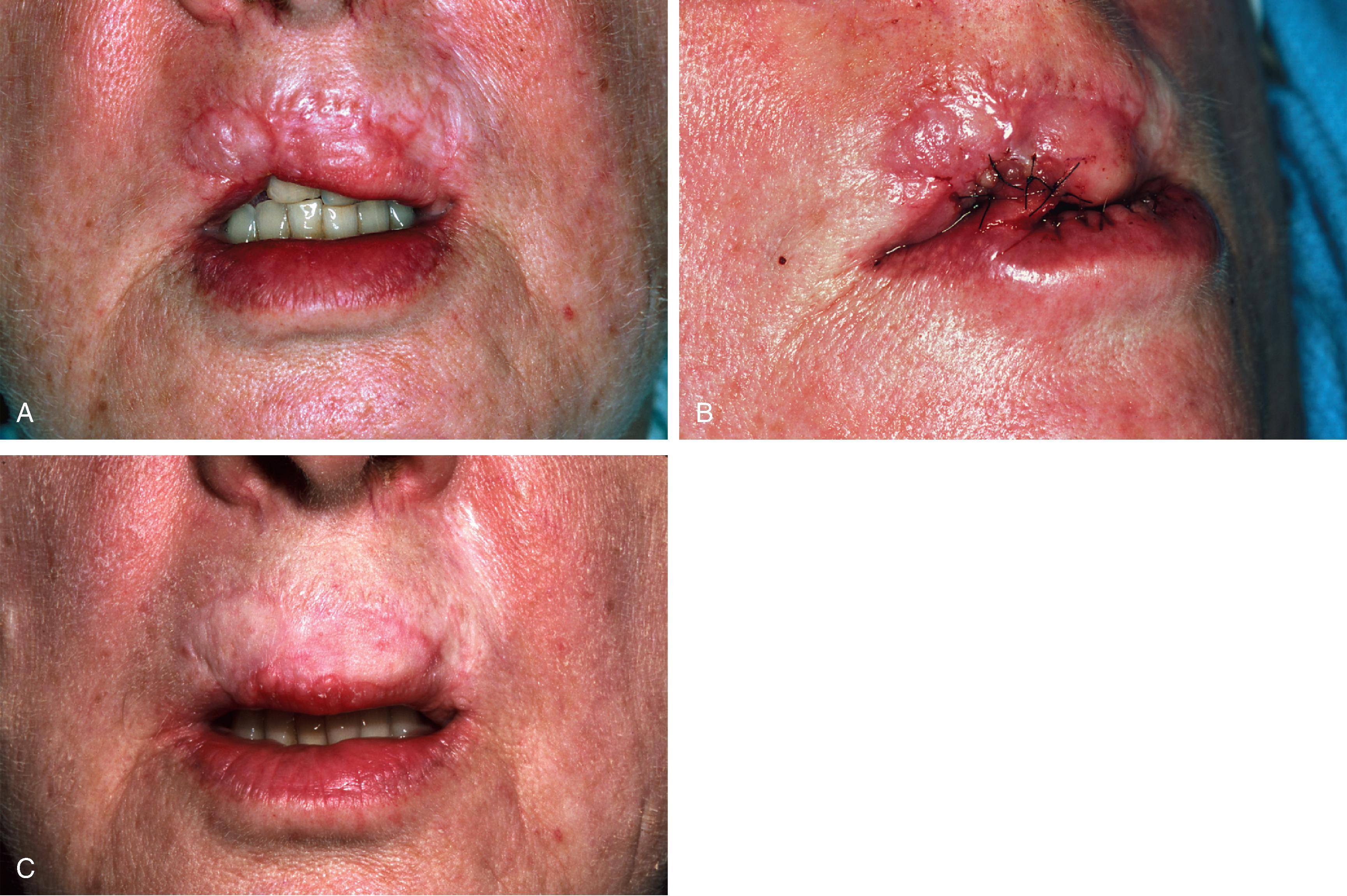 FIG. 19.9, A , Loss of vermilion of right lateral aesthetic unit of upper lip. B , Unipedicle interpolated cross lip vermilion flap transferred from lower lip to upper lip. Pedicle must be adequate to accommodate for repeated motion of lip during first stage. C , After vermilion cross lip flap inset to restore vermilion and full-thickness skin graft to replace missing skin of lip.