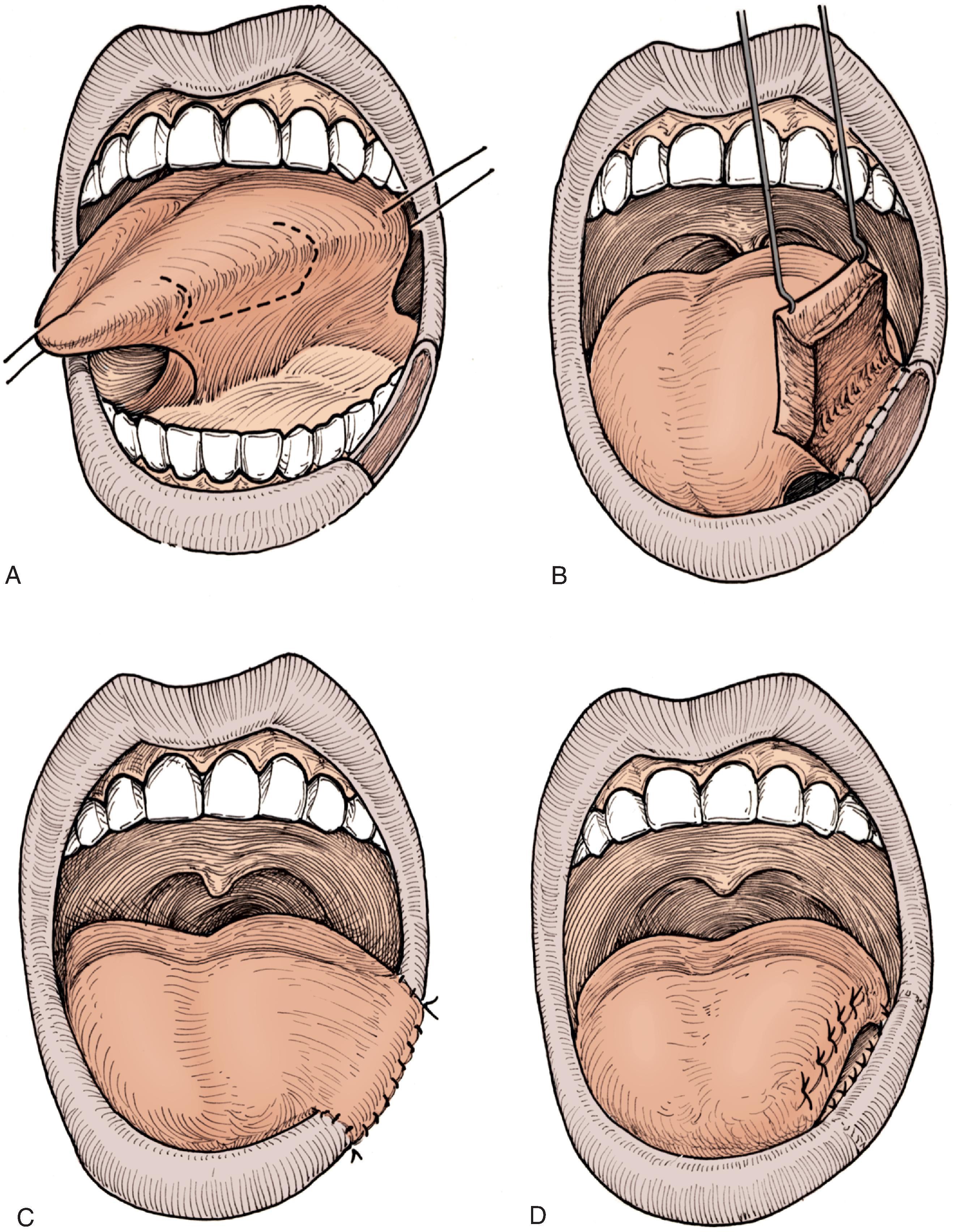 FIG. 19.10, A , Defect of lower lip vermilion and outline of superiorly based tongue flap. B , Inferior margin of tongue donor site anchored to inner margin of lip defect. C , Tongue flap transferred to vermilion defect. D , Three weeks later, the pedicle is divided and flap inset, completing the reconstruction of vermilion.