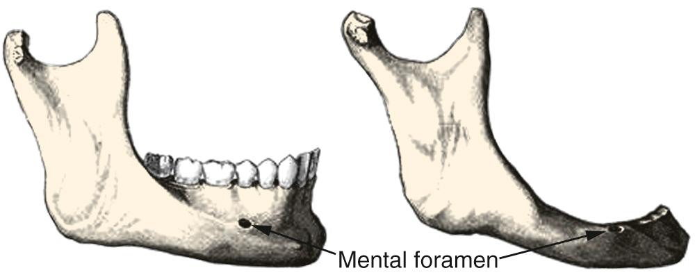 Fig. 92.2, Comparison of dentulous versus edentulous mandible.