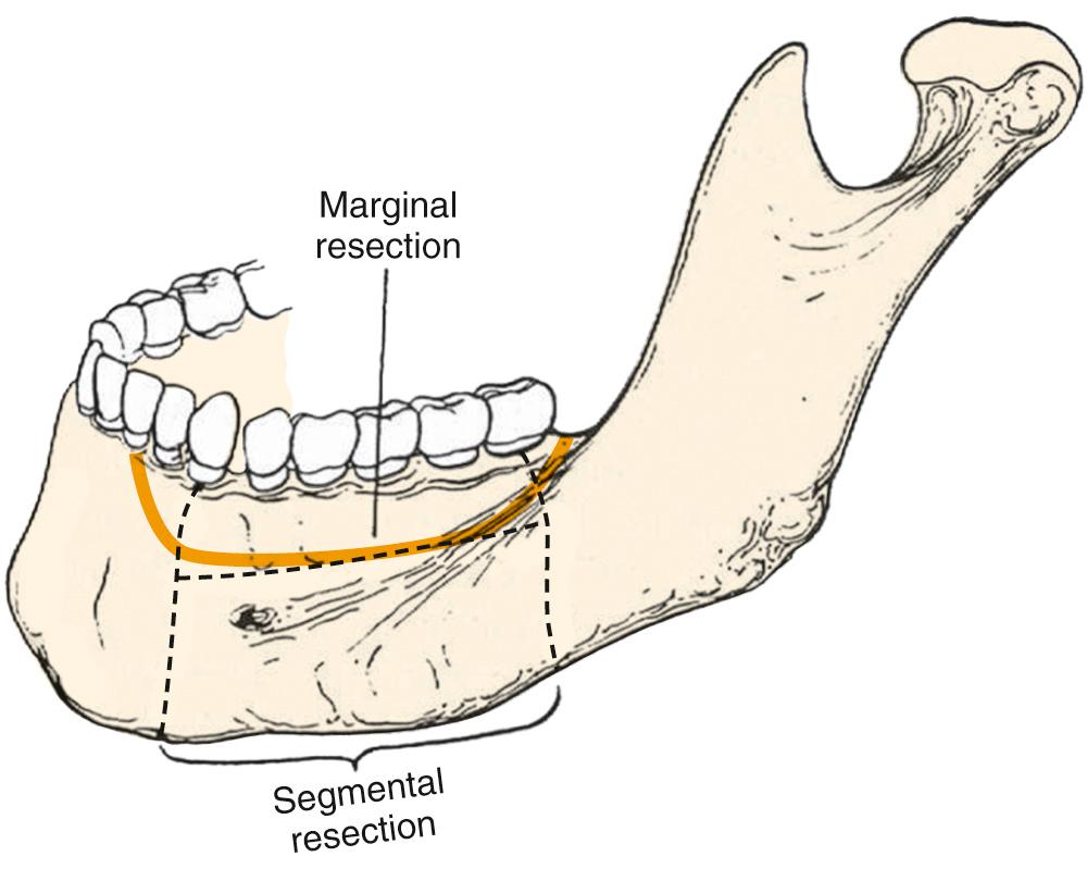 Fig. 92.3, Segmental versus marginal mandibulectomy.