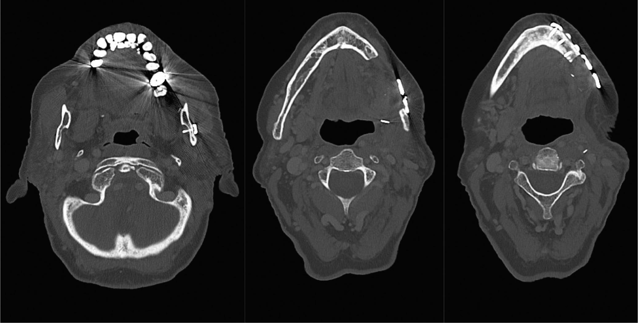 Fig. 92.5, CT scan demonstrating a larger and more anterior defect in an 89-year-old patient who refused free flap reconstruction, opting for a plate only. Note the improved symmetry and alignment of the lower teeth in the third panel, without the deviation to the deficient left side as demonstrated in Fig. 92.4 .