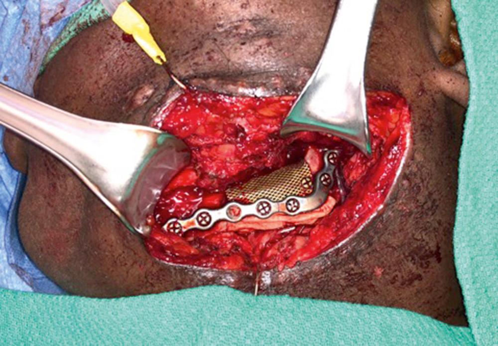 Fig. 92.6, Patient with traumatic defect of the left body and angle of the mandible. Vascular anatomy of the bilateral lower extremities precluded fibular free flap harvest. Reconstruction was performed with reconstruction plate and a titanium mesh crib filled with crushed bone graft and rh-BMP.