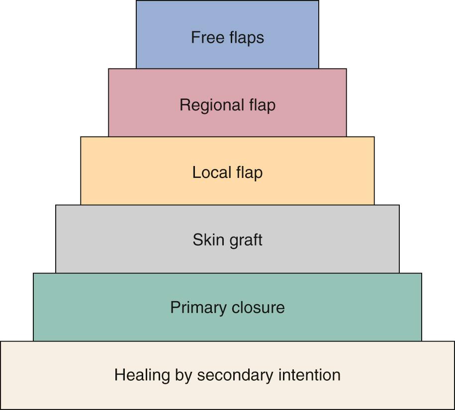 Fig. 98.2, A reconstructive ladder is an organized method of working through the various options of reconstructing a defect, starting with the simplest and working through to the most sophisticated. Routine use of the ladder will ensure that no possible reconstructive modalities are overlooked.