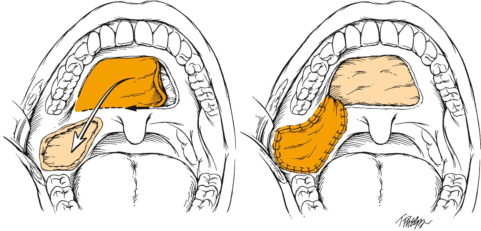 Fig. 98.3, The palatal island flap consists of hard palatal mucoperiosteum pedicled on a single greater palatine pedicle. It is ideal for reconstructing limited defects of the soft palate, tonsil, and retromolar trigone.