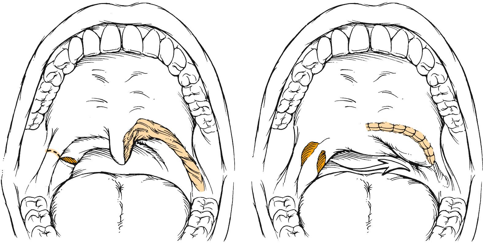 Fig. 98.4, Uvulopalatal flap.