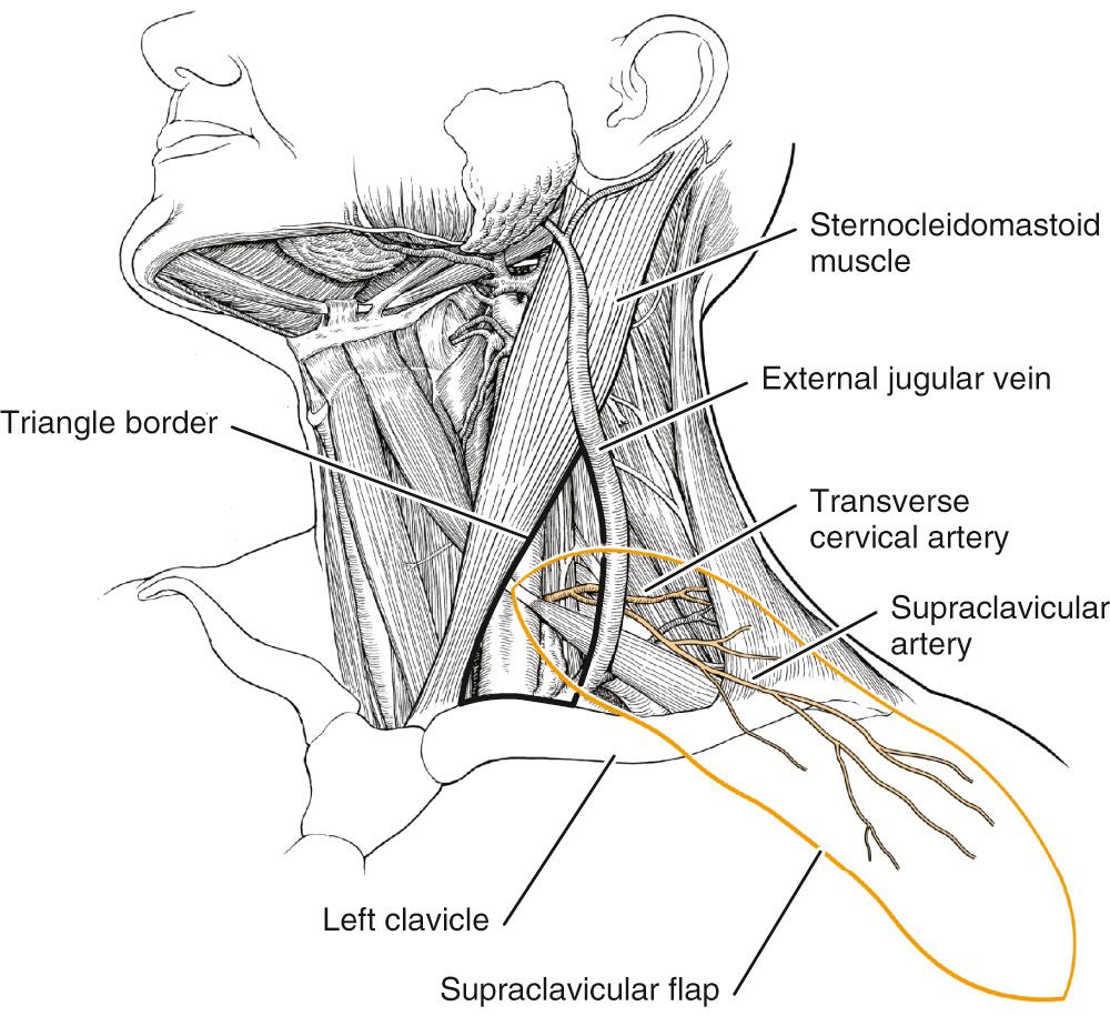 Fig. 98.6, Supraclavicular flap.