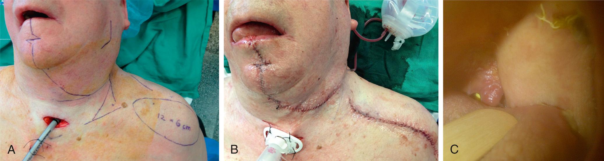 Fig. 98.7, Supraclavicular flap for lateral pharyngeal reconstruction.