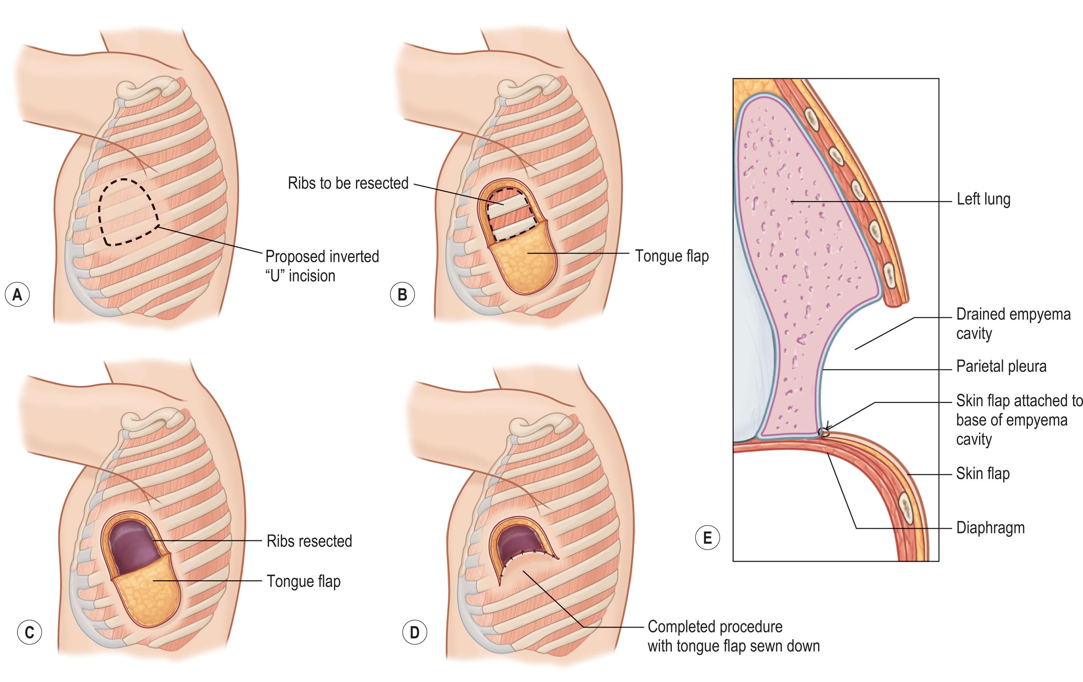 Figure 11.1, The Eloesser flap involves an inferiorly based U-shaped flap that allows resection of the anterolateral portion of 2–4 ribs such that the skin flap can be sutured to parietal pleura, allowing for controlled drainage of empyema.