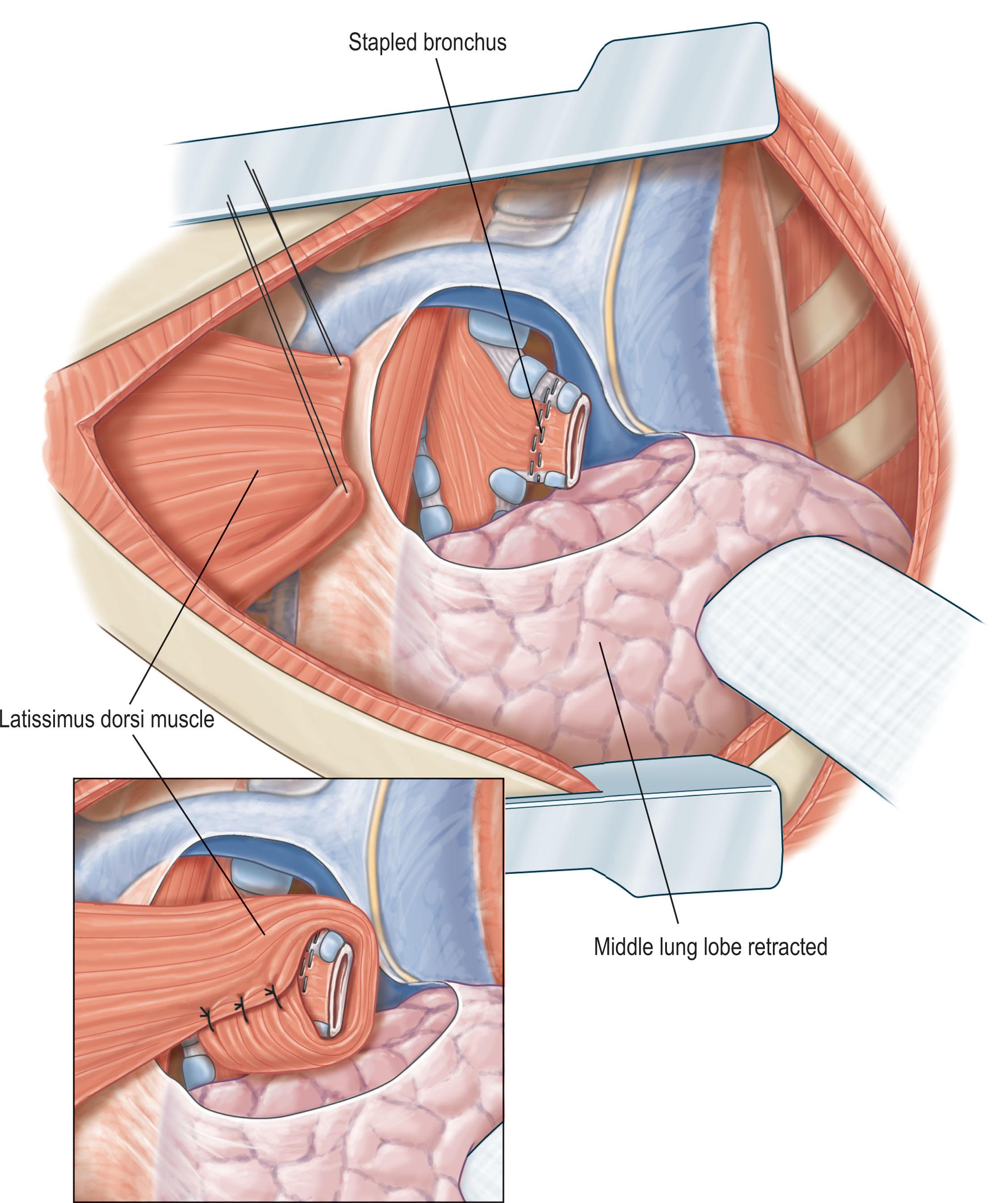 Figure 11.2, Reinforcement of a bronchial stump closure with a tunneled latissimus dorsi muscle flap.