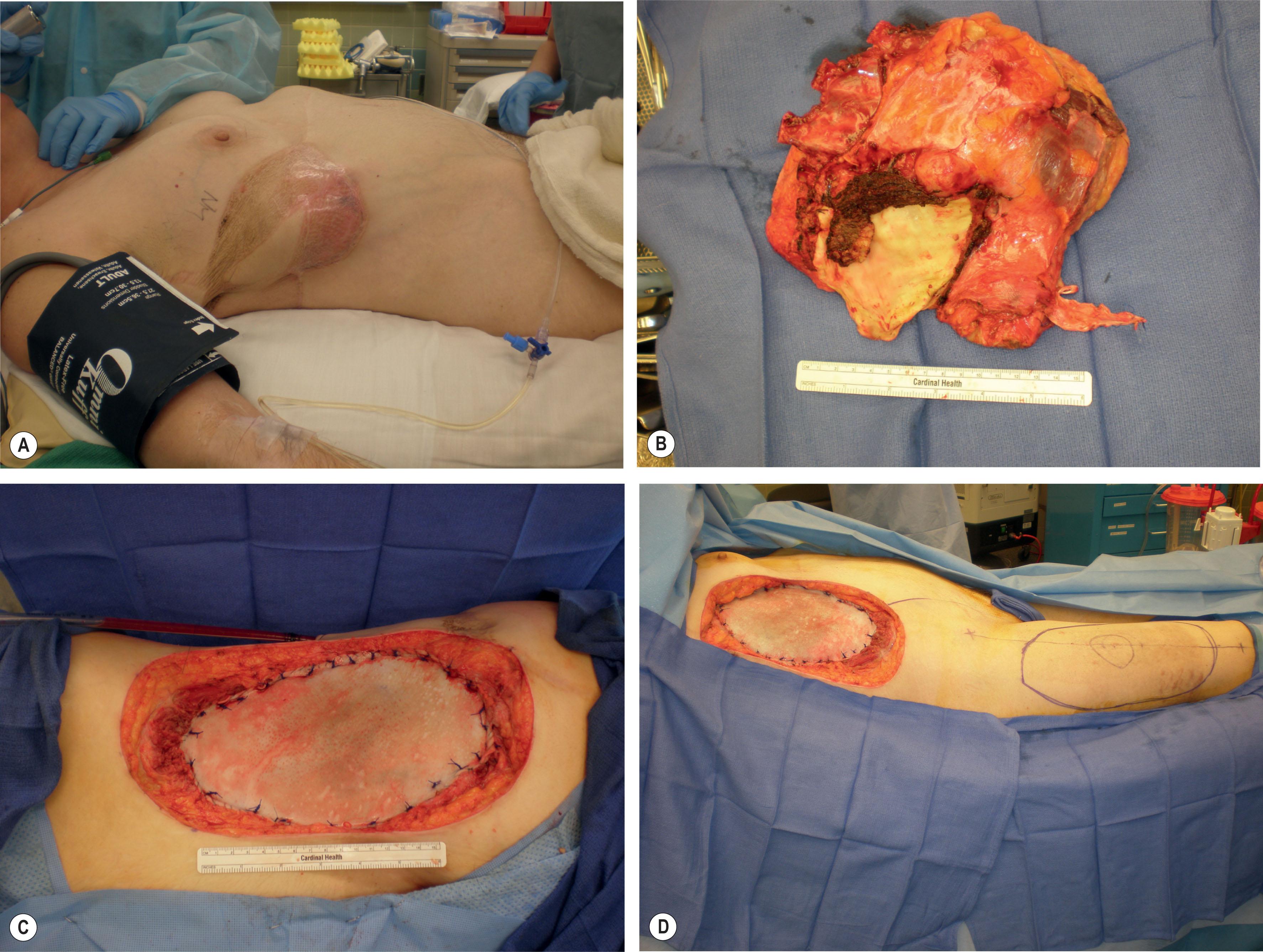 Figure 11.3, (A) Patient presenting with recurrence of osteosarcoma following initial reconstruction with latissimus flap. (B) Resection of tumor, prior latissimus flap, prior mesh, and multiple ribs. Reconstruction of rib defect with biologic mesh (C) and free anterolateral thigh (ALT) flap to the deep inferior epigastric artery (DIEA) and vein (DIEV) (D) .