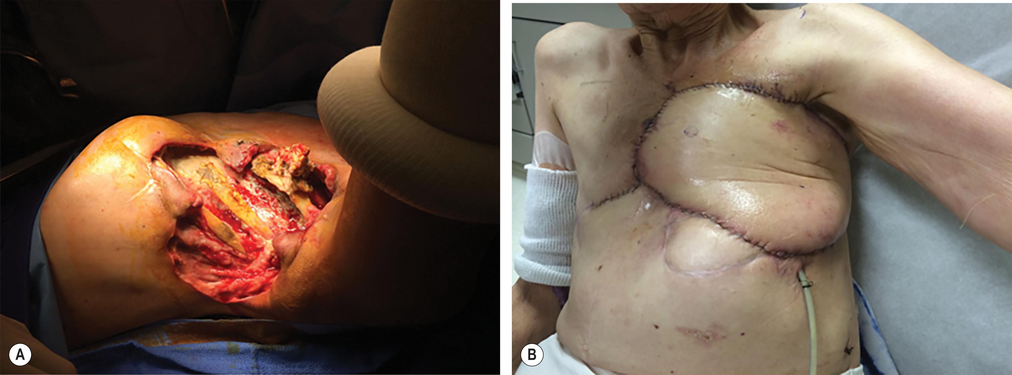 Figure 11.4, Patient with osteoradionecrosis of the left chest wall (A) treated with radical debridement and reconstruction with free anterolateral thigh (ALT) flap (B) .