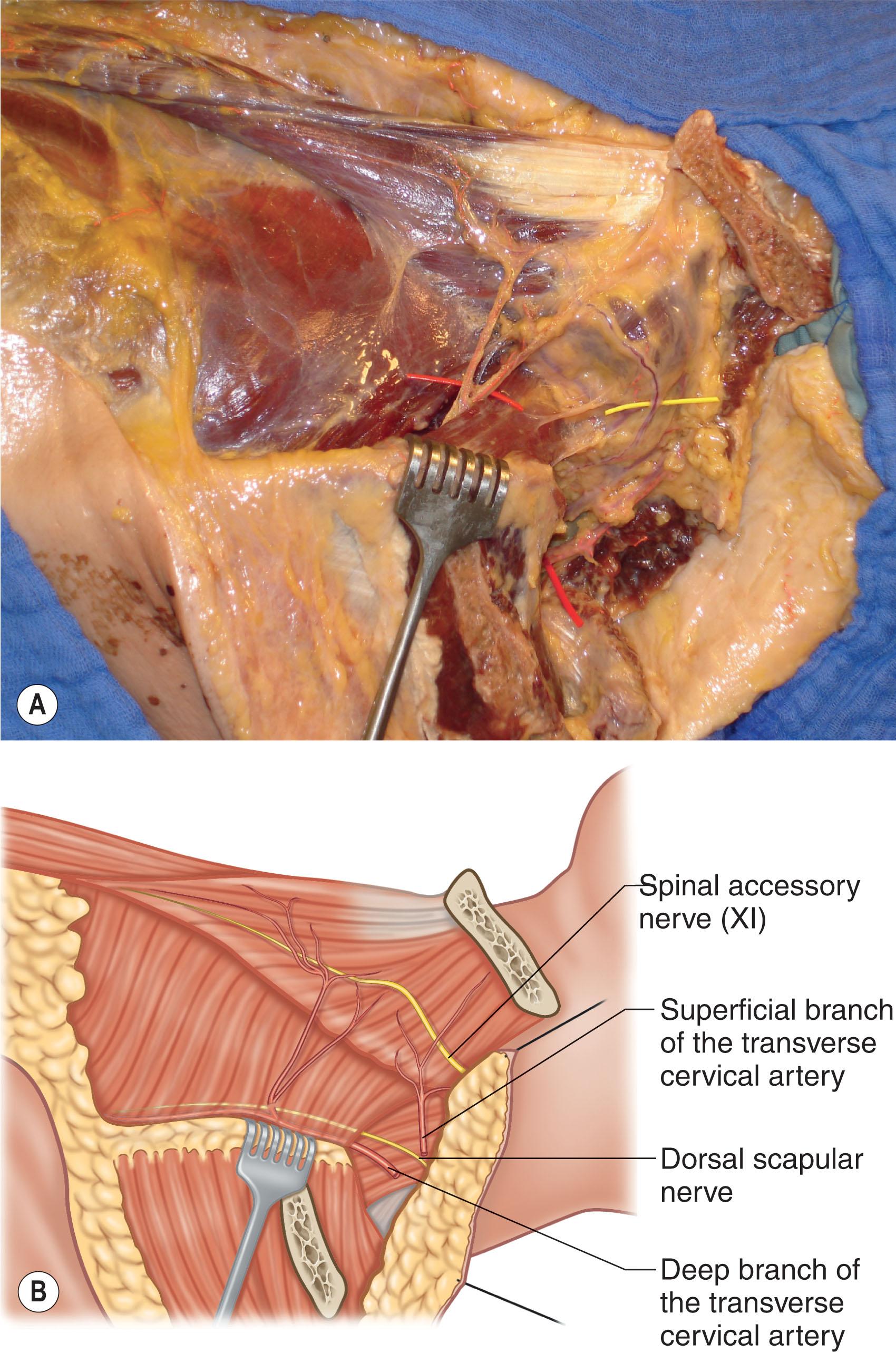 Figure 12.11, Trapezius flap. The dissection plane and blood supply to the trapezius muscle flap. (A) Demonstrates the anatomic dissection of a trapezius muscle flap. The deep and superficial branches of the transverse cervical artery are noted with red and the spinal accessory nerve is noted with yellow. (B) Illustrates the above photograph with identification of important structures.