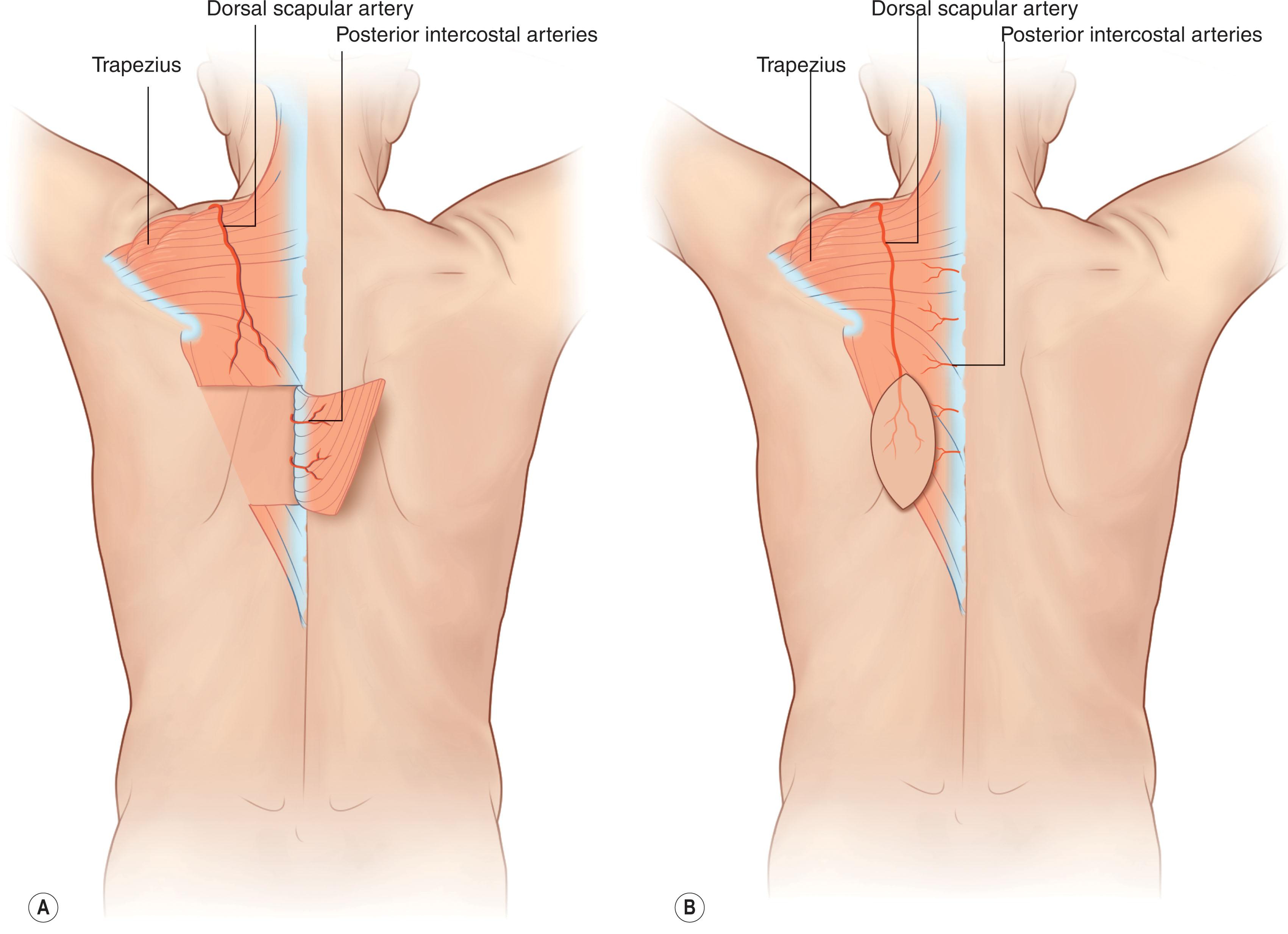 Figure 12.12, Trapezius flap variations. The trapezius flap is a versatile flap that can be based either on its primary or secondary blood supply, allowing for great flexibility in flap design. (A) Demonstrates a turnover trapezius muscle flap based off the posterior intercostal arteries. (B) Demonstrates a fasciocutaneous pedicled perforator flap based off the dorsal scapular artery.